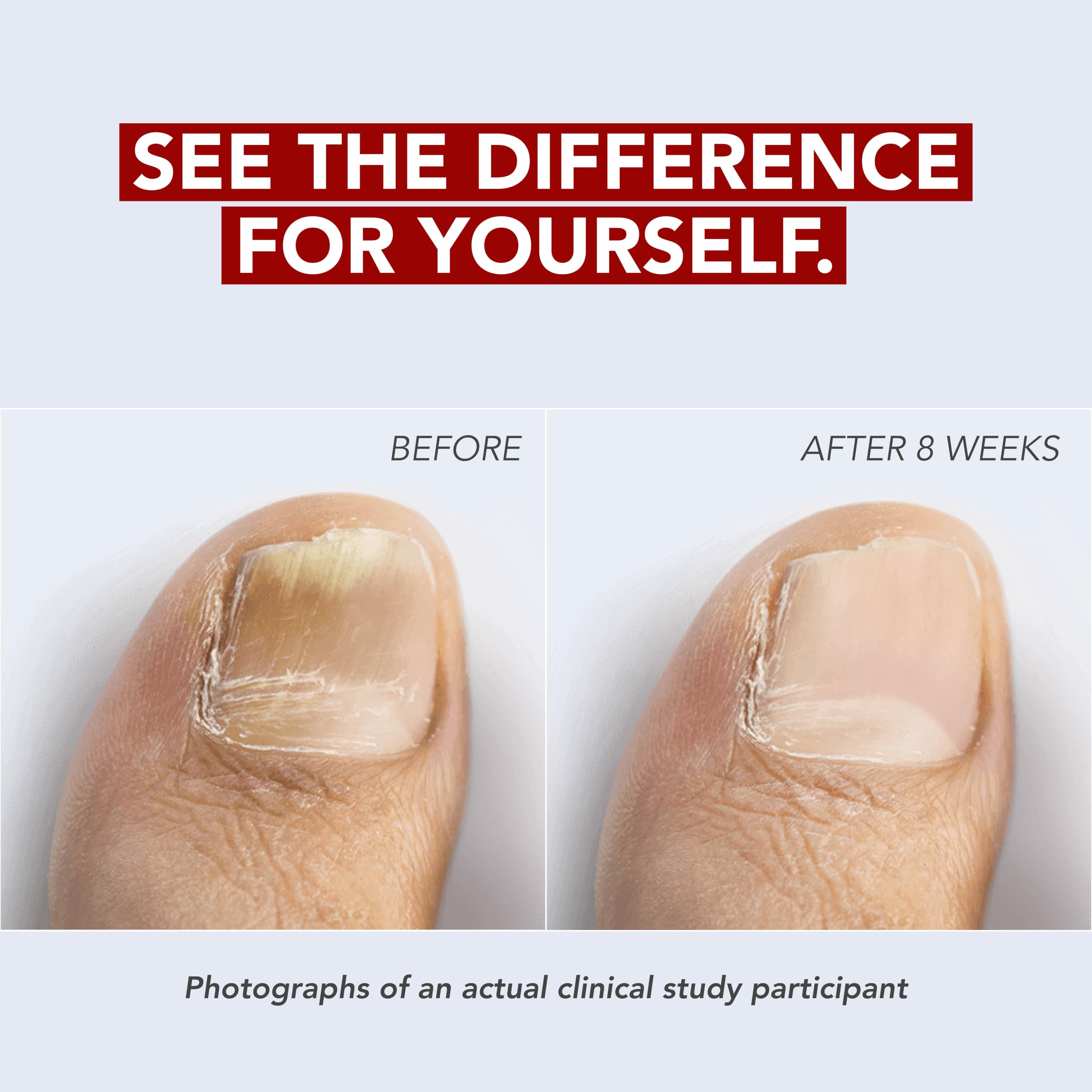 Kerasal Nail Renewal Restorative Nail Repair for Damaged Nails 0.33 oz | Restorative nail repair with Urea helps improve the appearance of damaged discolored nails with quick visible results. product thumbnail 6