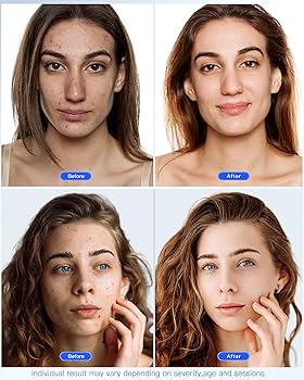 海外プロ使用❗️アートメイクセット❗️ Amazon.com : NEWKEY Red Blue Light Therapy for Face, LED