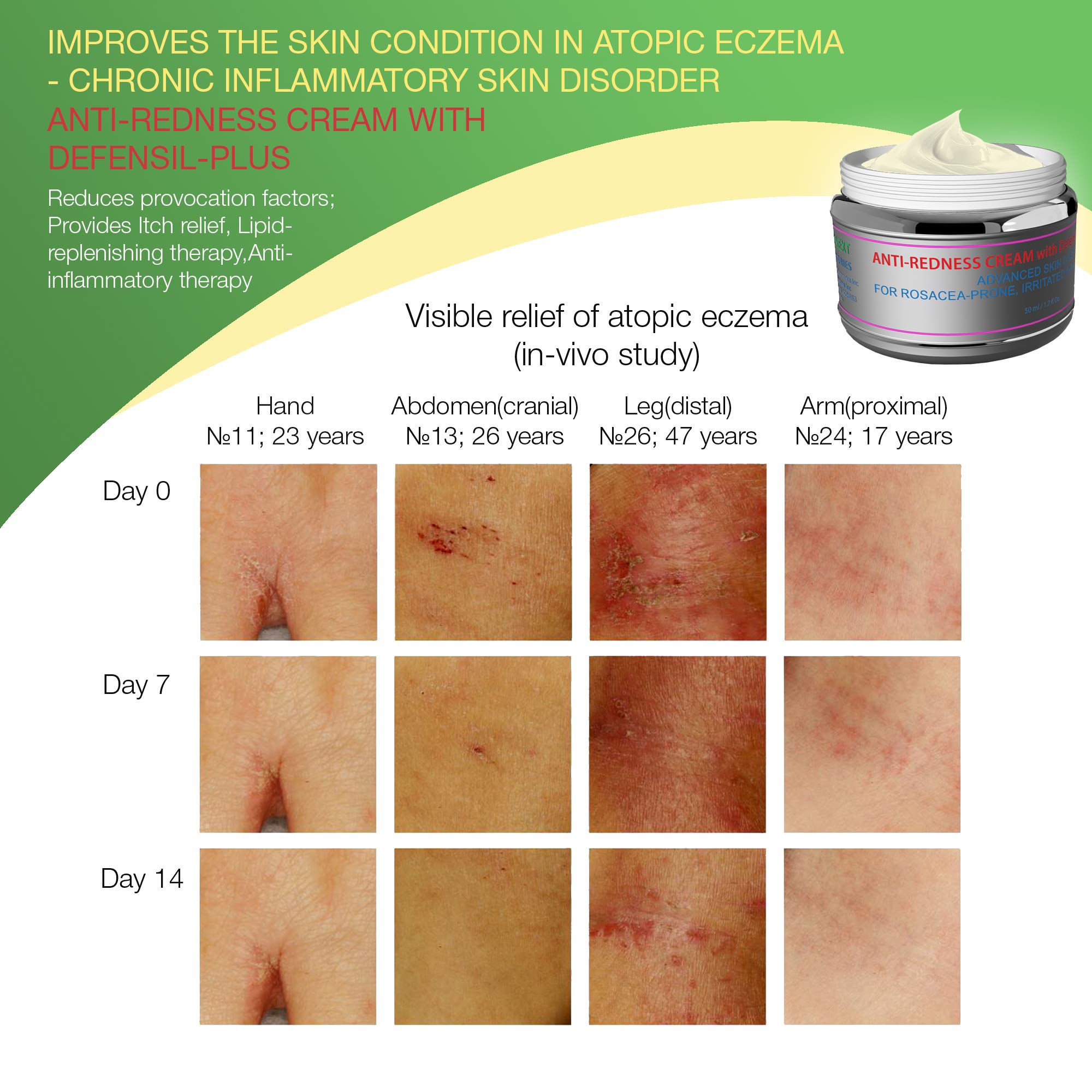 Redness Relief Face Eczema Cream AllNatural Anti Itch Cream Fast