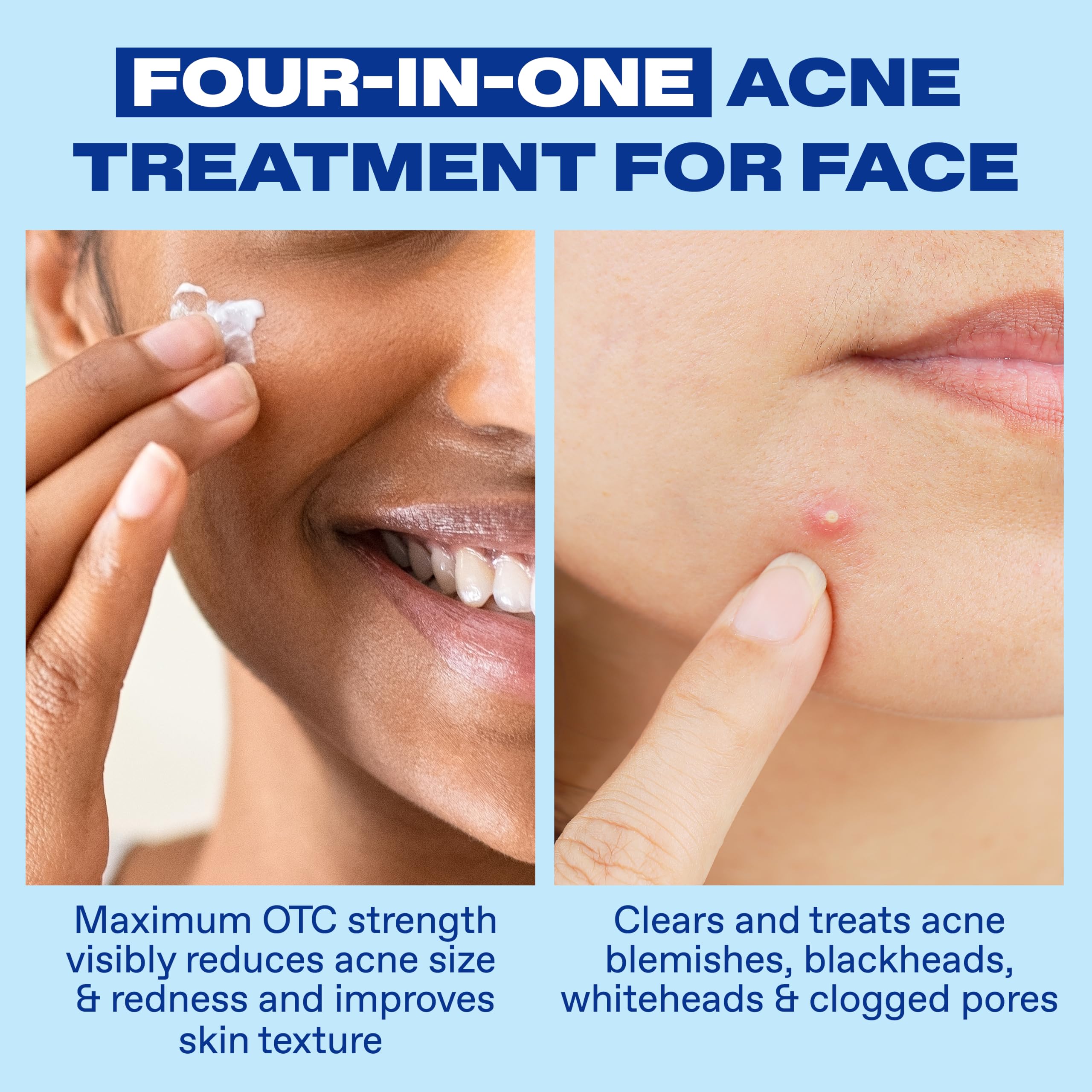 Differin Acne Spot Treatment - 10% Benzoyl Peroxide -3