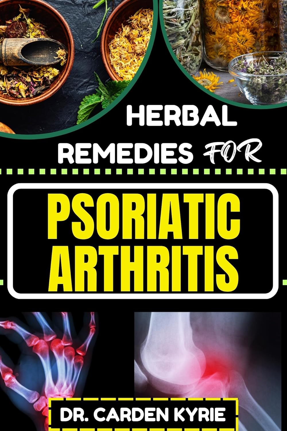 HERBAL REMEDIES FOR PSORIATIC ARTHRITIS Empower Your
