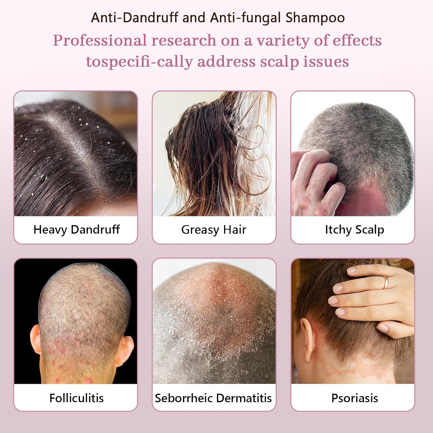 Anti-Fungal Shampoo for Seborrheic Dermatitis, Folliculitis, and Psoriasis, Dandruff Shampoo for Men & Women, Relief for Dry, Itchy Scalp, Sulfate & Paraben-Free, 8.4 fl oz