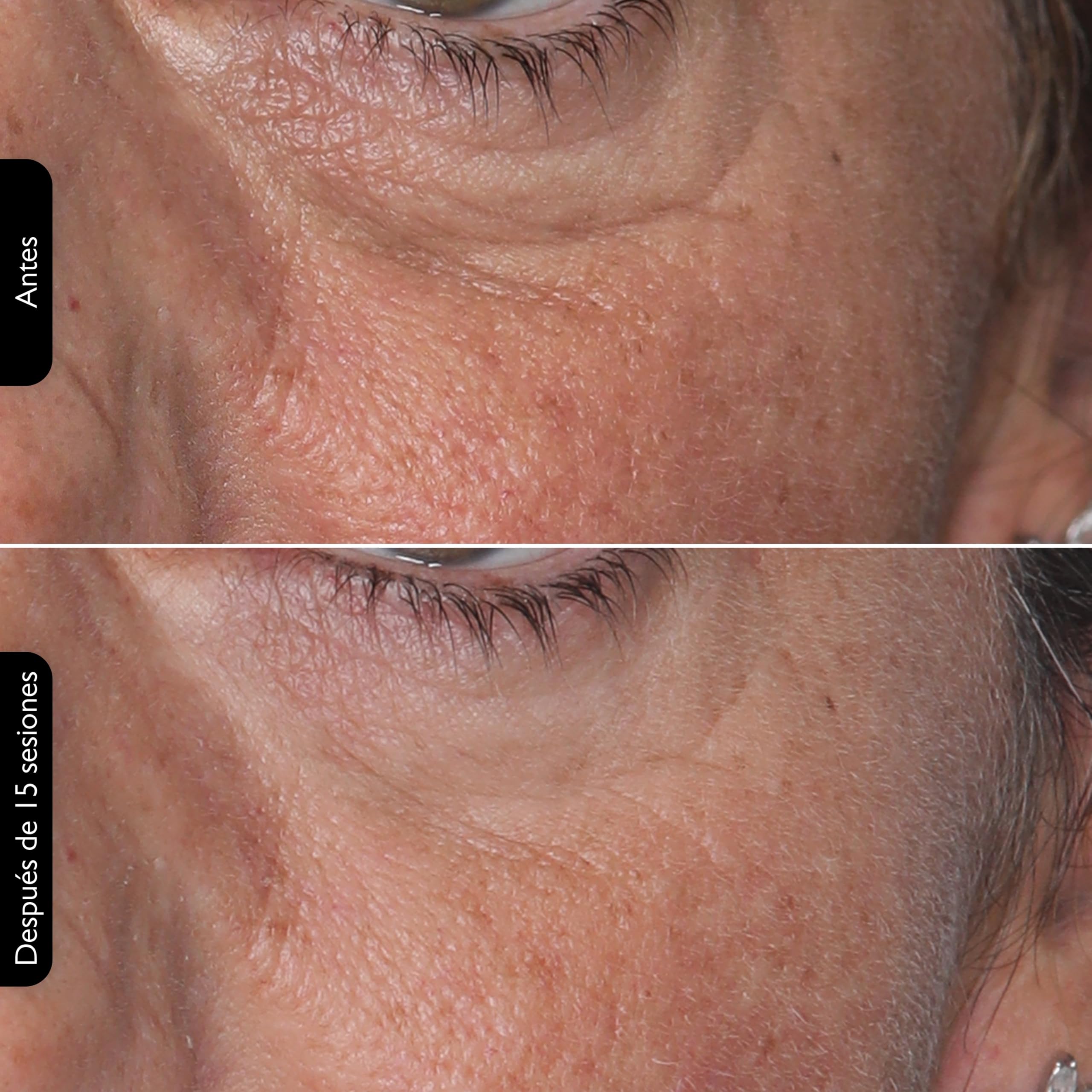 Silk'n Máscara LED Facial I Face LED Mask I Mascarilla para Rejuvenecer la Piel y Reducir Manchas I Luz Roja, Azul, Amarilla y Violeta I Blanca