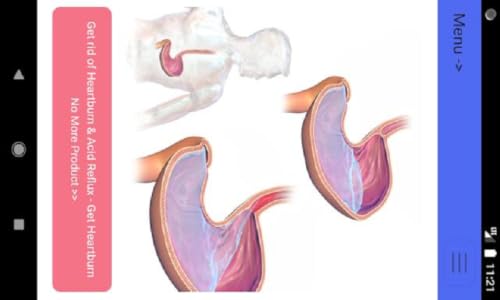 Acid Reflux Heartburn Cure App - Get rid of Acid Reflux – vue 2