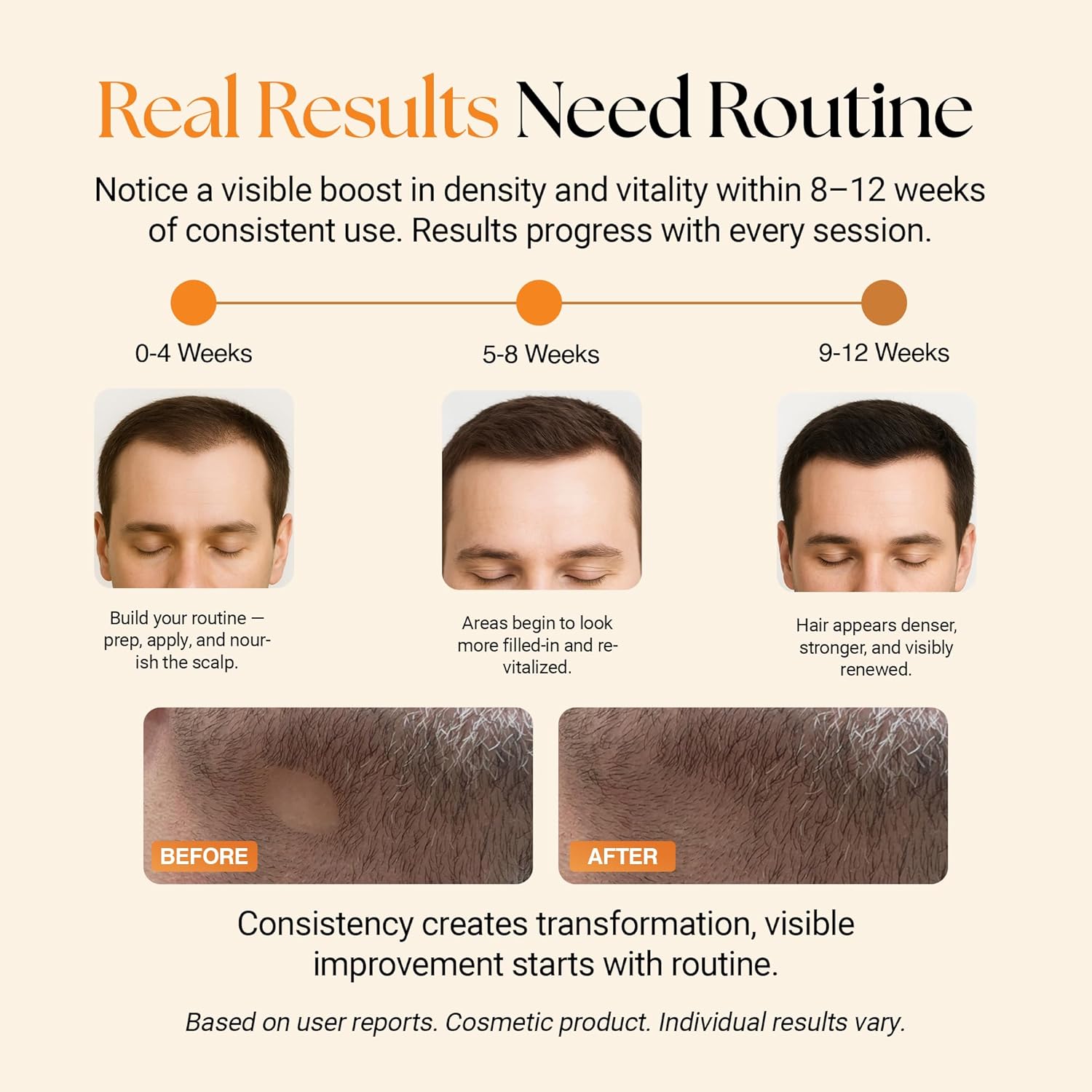 ReGlow Micro-Infusion Hair Density System with Precision Applicators & Bio-Active Serum with Plant Exosomes-like Vesicles & Stem Cell – 6 Applications for Fuller-Looking Hair and Beard