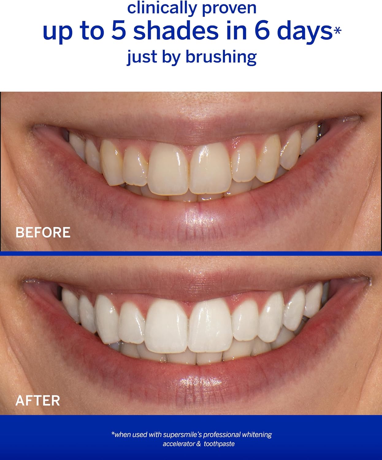 Supersmile Wild Mint Whitening System with Fluoride – Professional Grade 2-Step Whitening Toothpaste and Accelerator – Whitens Up to 6 Shades, 8 oz Each