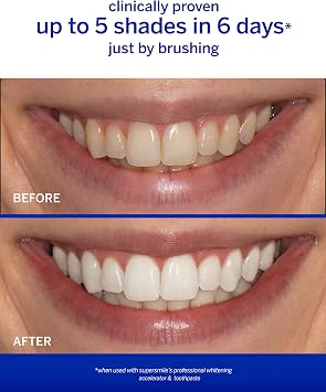 Supersmile Wild Mint Whitening System, 8 Oz Toothpaste + Accelerator | Lime + Cinnamon Bark + Basil + Peppermint, Whitens Up to 6 Shades, Calprox + Fluoride, Veneer Safe, Cavity Protection