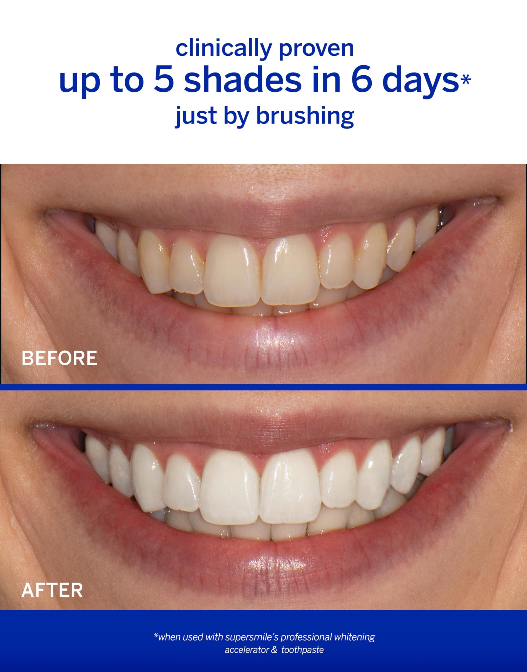 Supersmile Whitening System with Fluoride – Professional Grade 2-Step Whitening Toothpaste and Accelerator – Whitens Up to 6 Shades, 8 oz Each