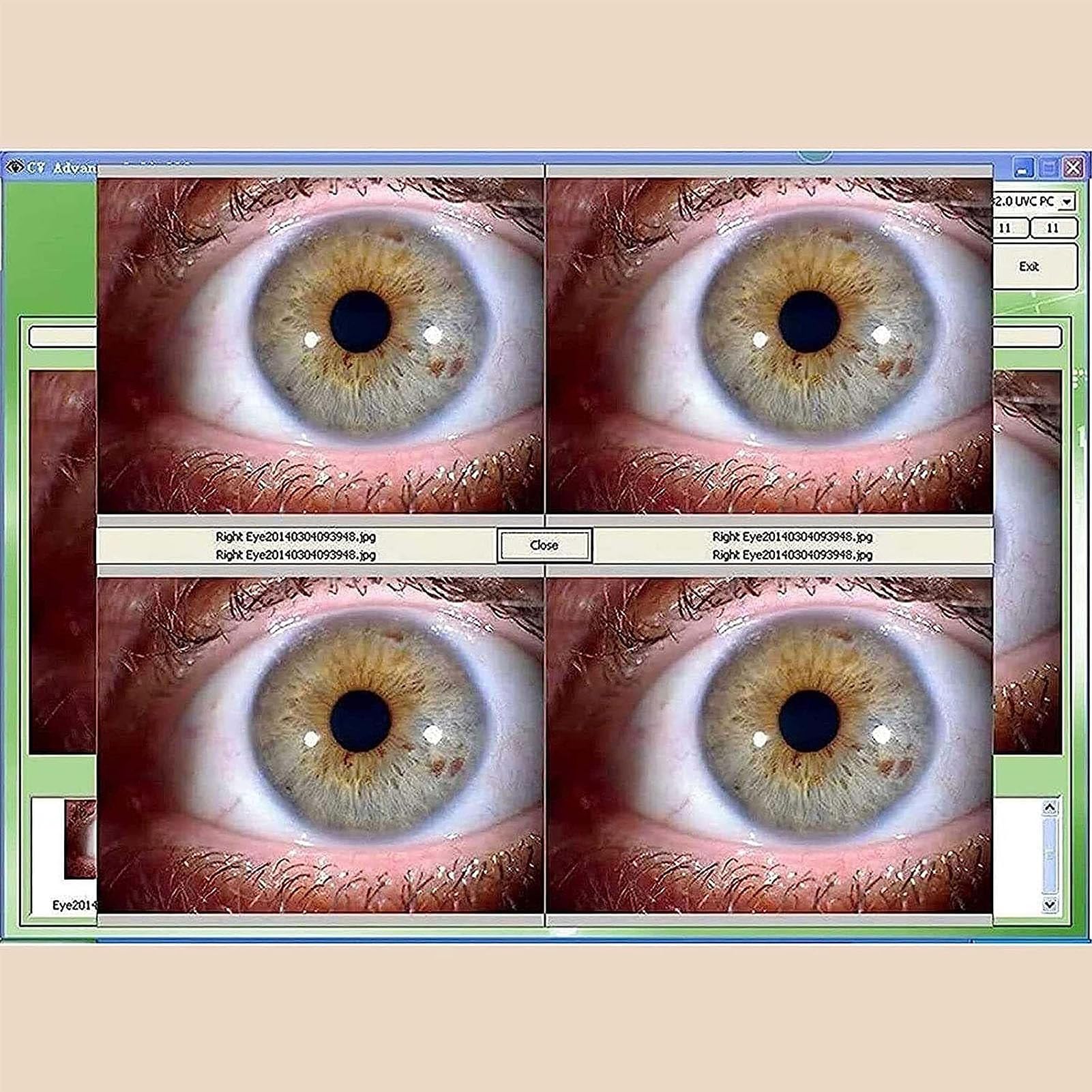 Telecamera di analisi dell'iride, Analizzatore Dell'iride Alternata con Obiettivo dell'iride HD 30X e Software di Analisi Senza Driver, Focus Regolabile ad Alta Risoluzione 2560 x 1920