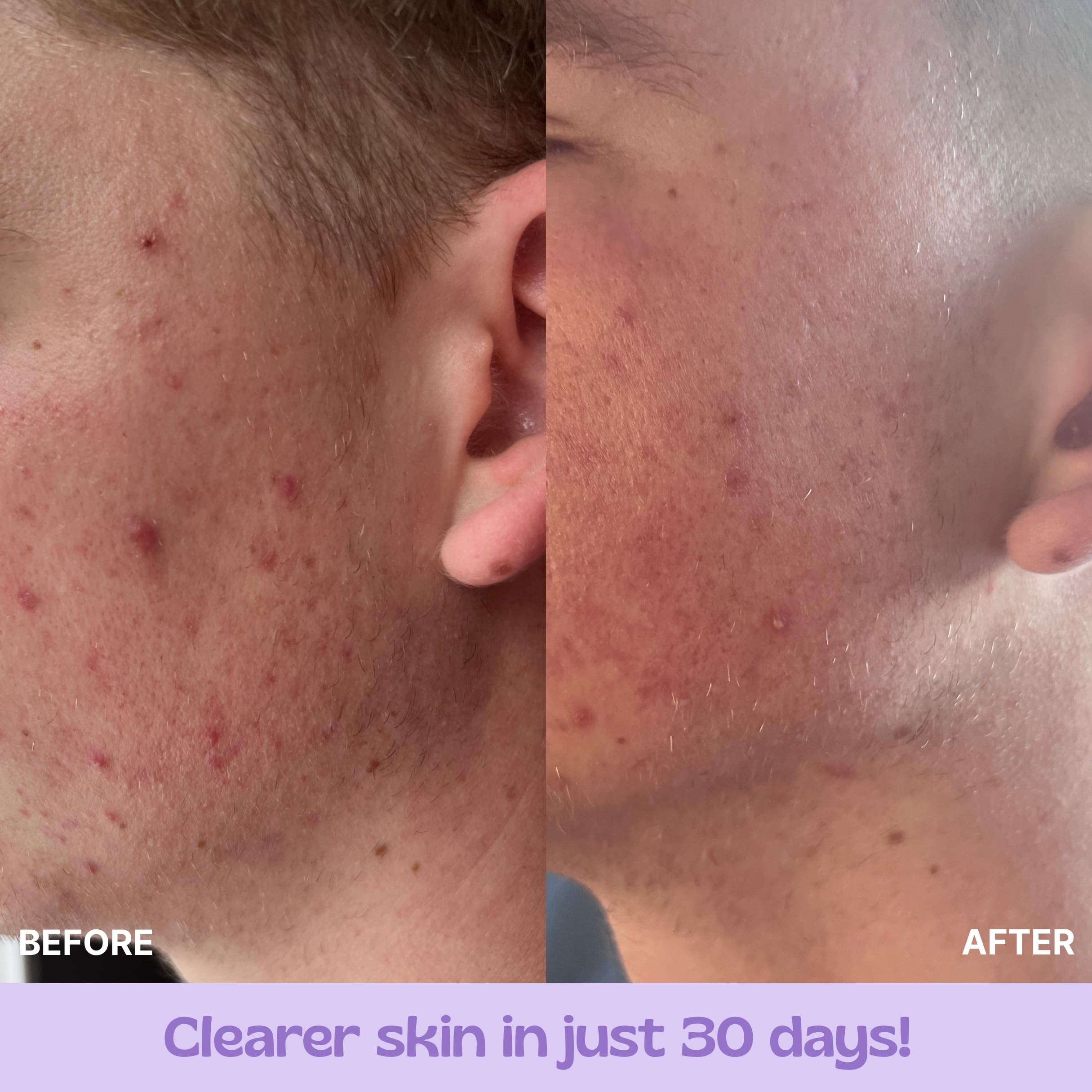 ghk cu acne scars before and after GHK-Cu for Skin: SIGNAL's Guide to Rejuvenation