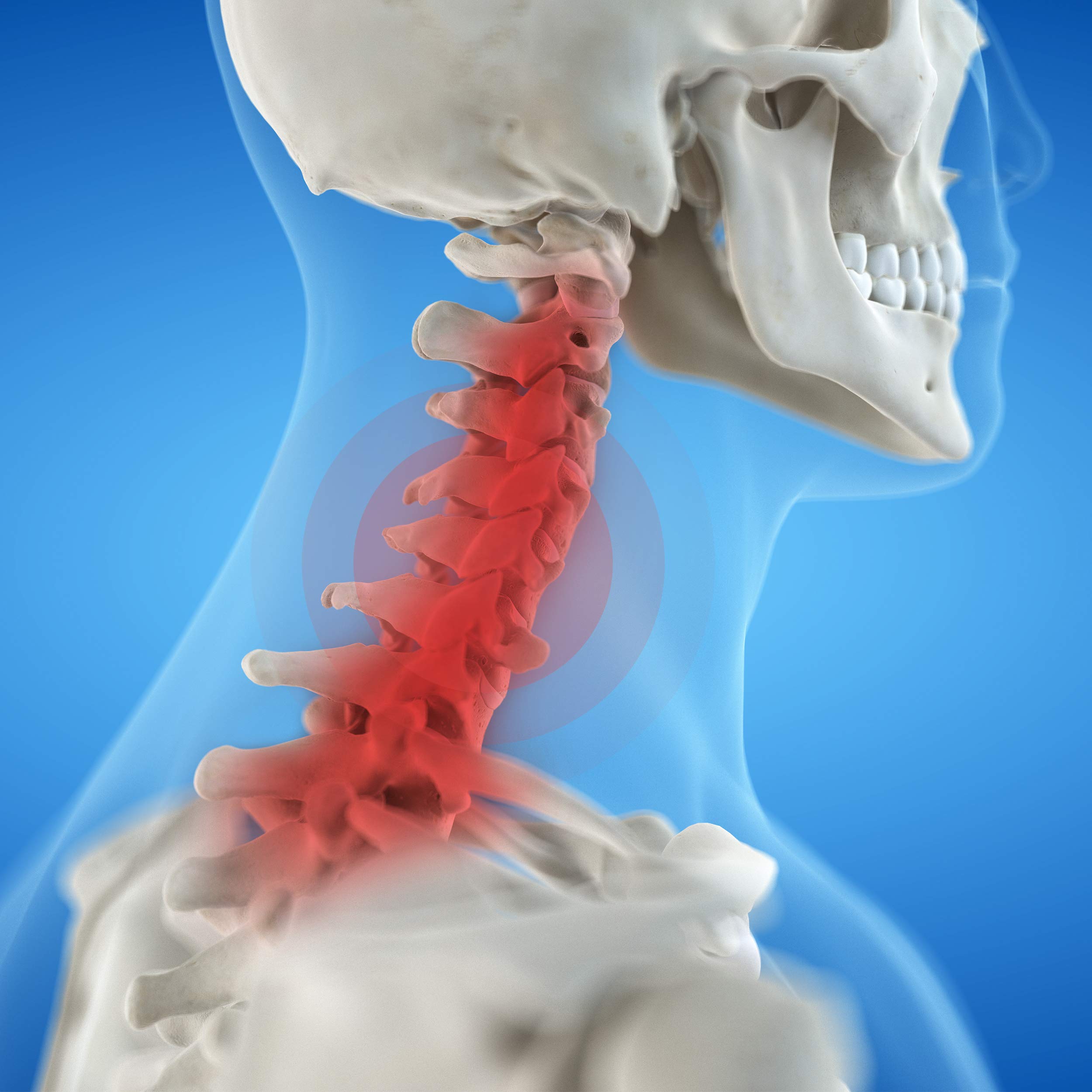 AIESI® Collare cervicale immobilizzante per adulti regolabile in 4 posizioni EASYLOCK