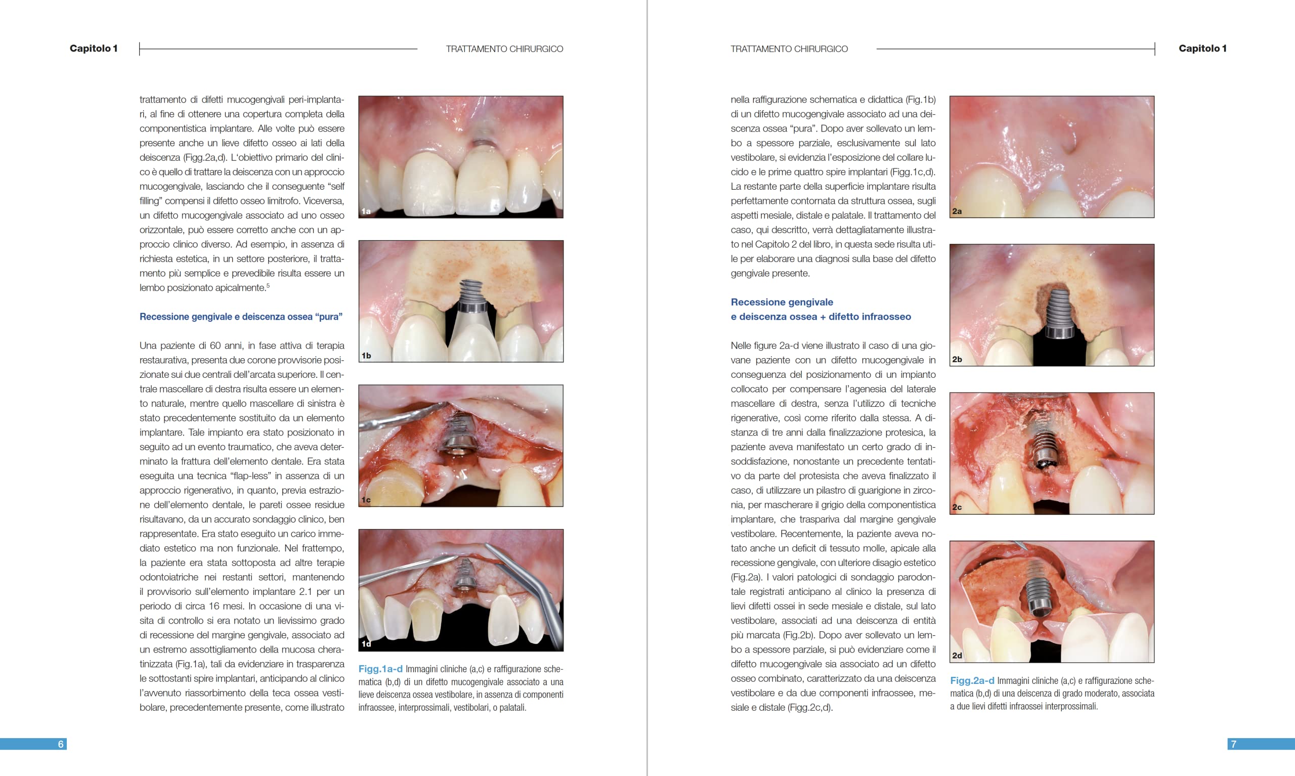 Malattie peri-implantari. Trattamenti chirurgici