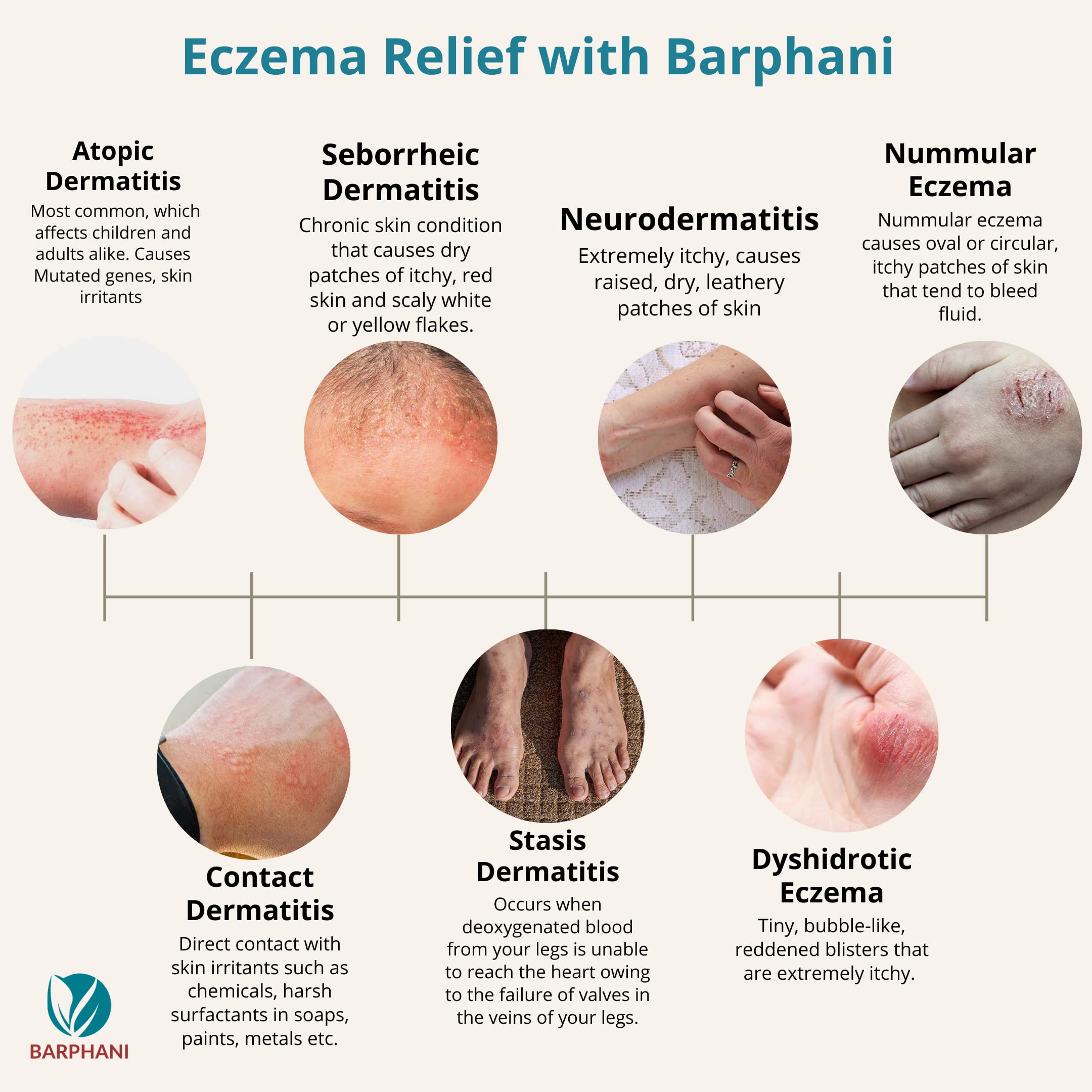 Barphani Maximum Strength Natural Eczema Cream. Ultimate Soothing for