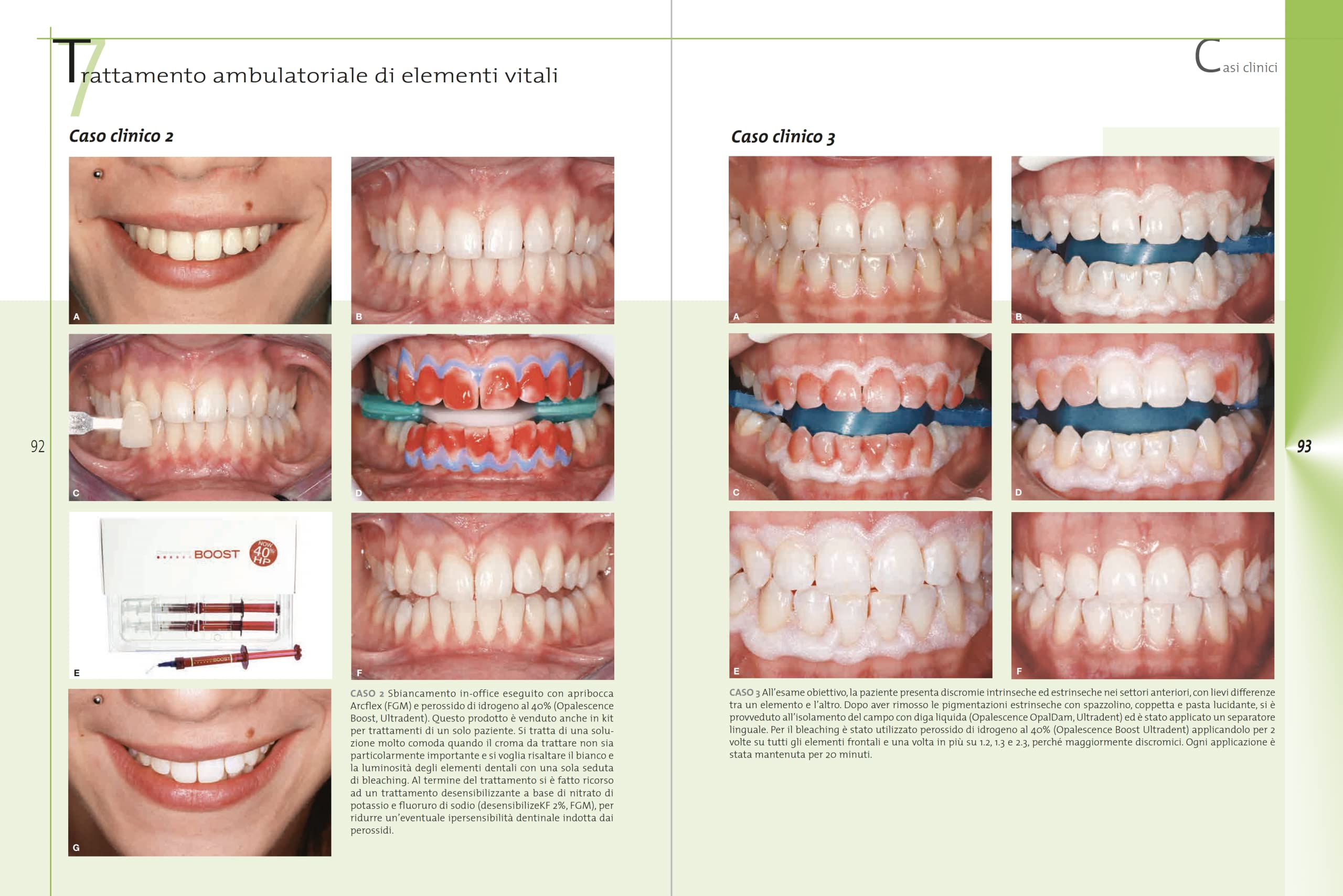 Sbiancamento dentale