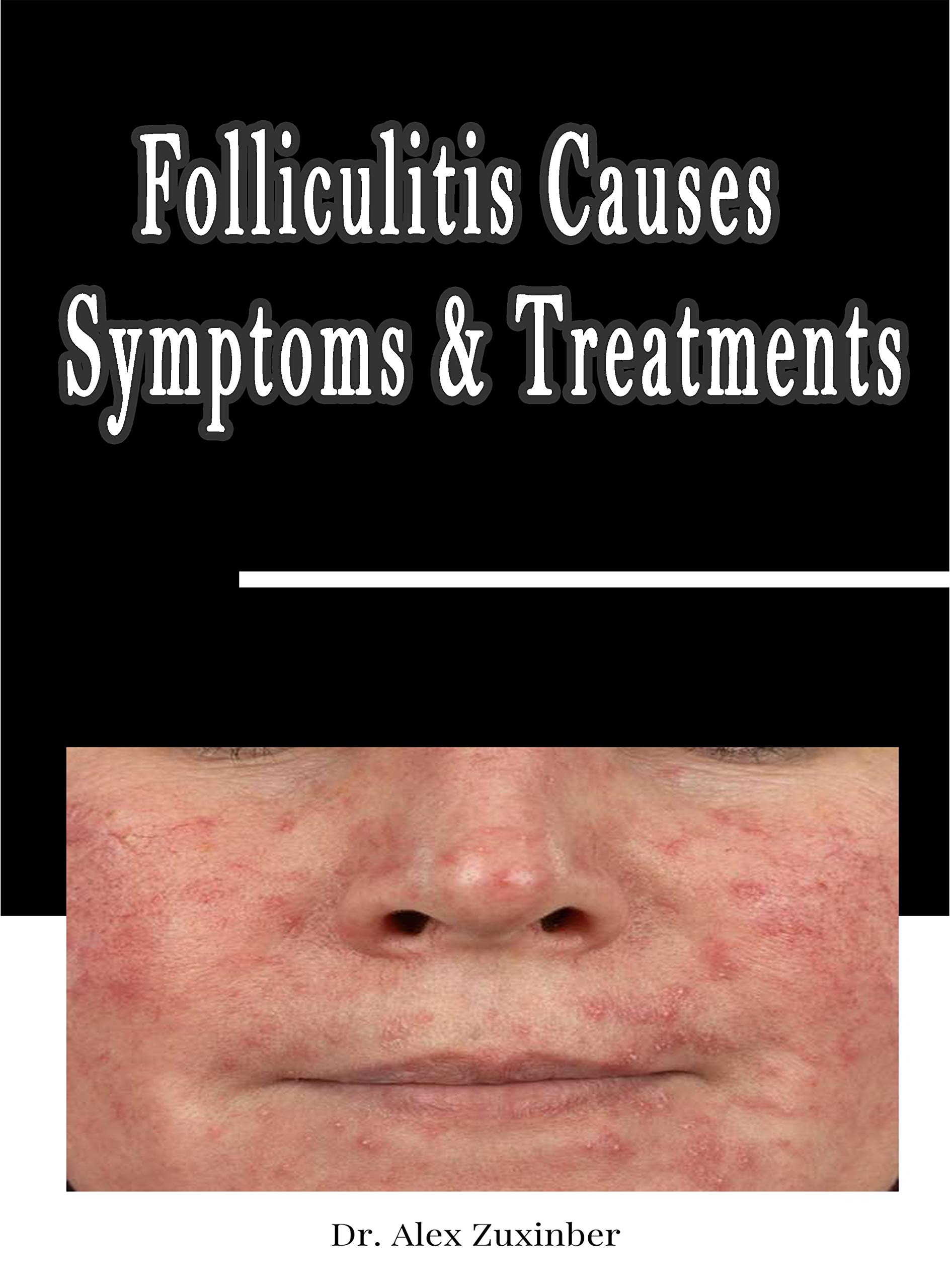 Buy Folliculitis Causes, Symptoms & s Bacterial Infection Fungal