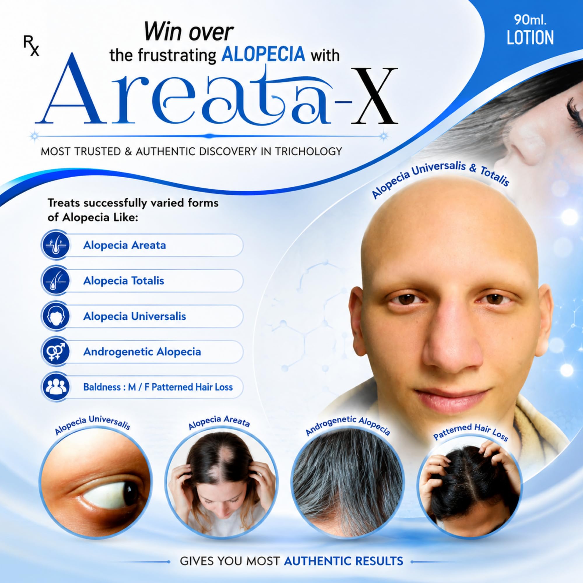 Global Pharma Alopecia Areata-X Hair Lotion Hair Care Solution for Bald Patches and Thinning 3