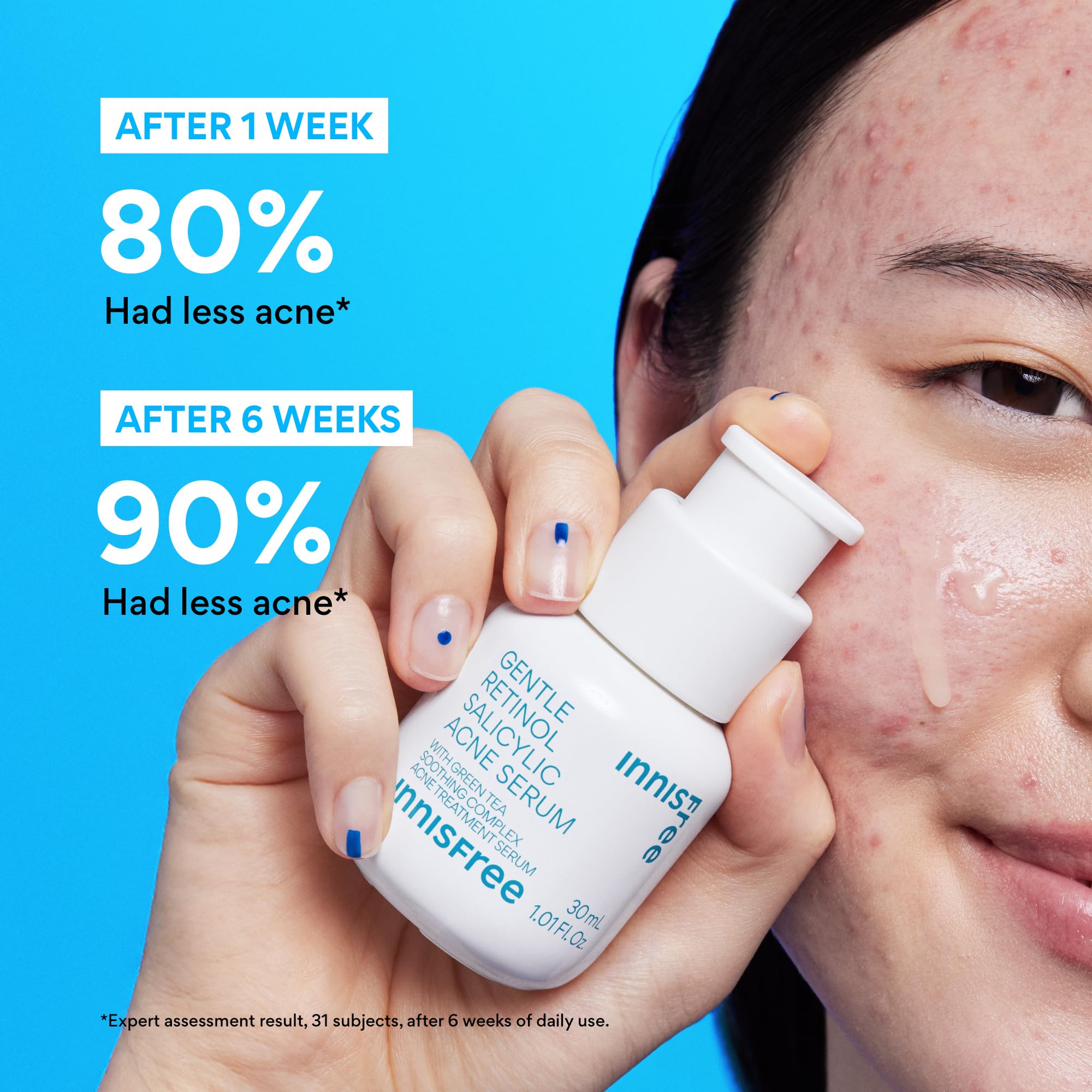 innisfree Gentle Retinol Salicylic Acne Serum, Korean Face Treatment for Blemishes and Clear Skin