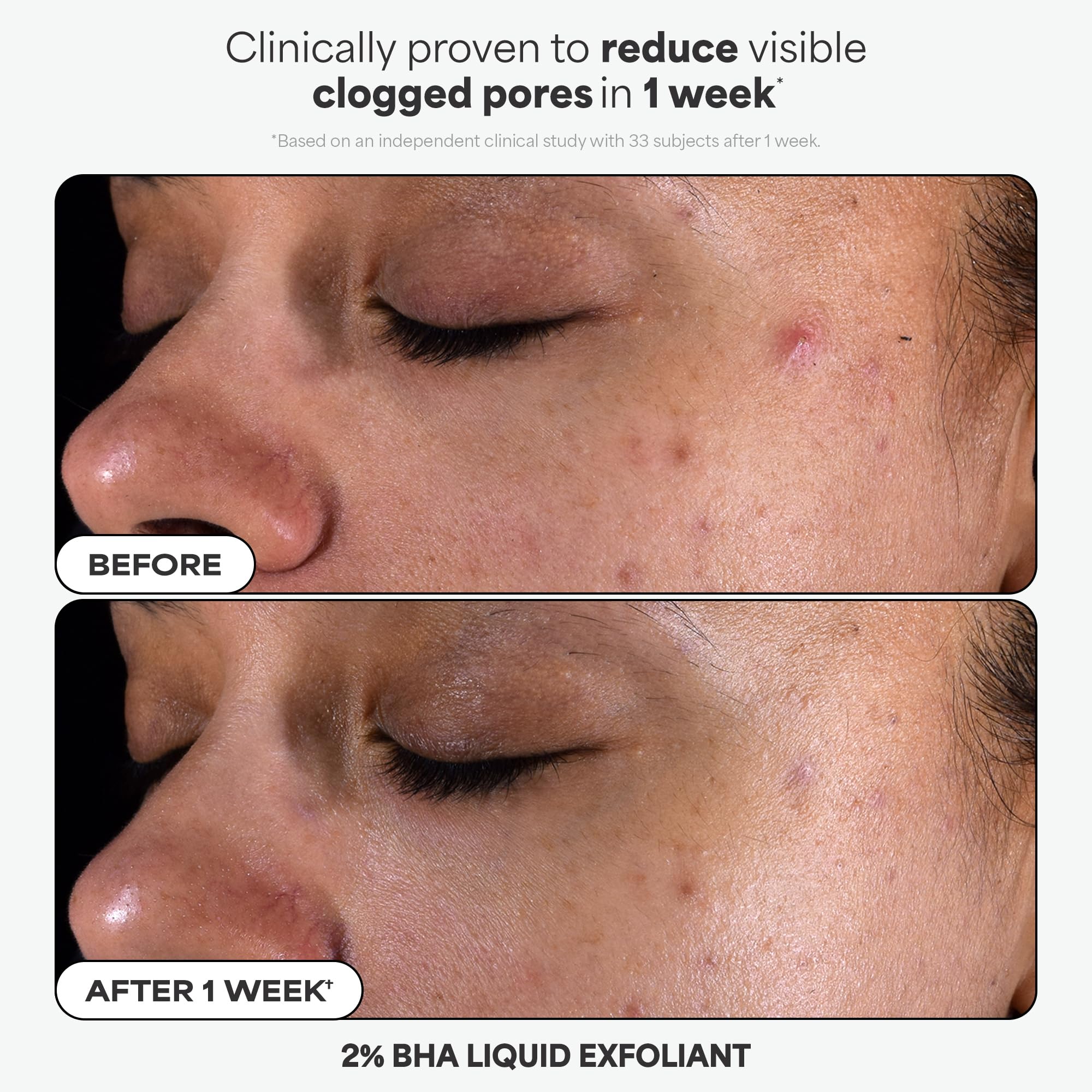 Paula's Choice Complexion Clarity Kit, 3 Piece Set Includes Full-Sized 2% BHA Exfoliant, 1% Retinol Treatment, Full-Sized 10% Azelaic Acid Booster, Skin Care Set for Clear, Glowing Skin