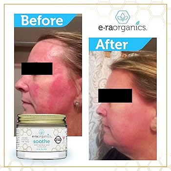 triamcinolone cream for rosacea
