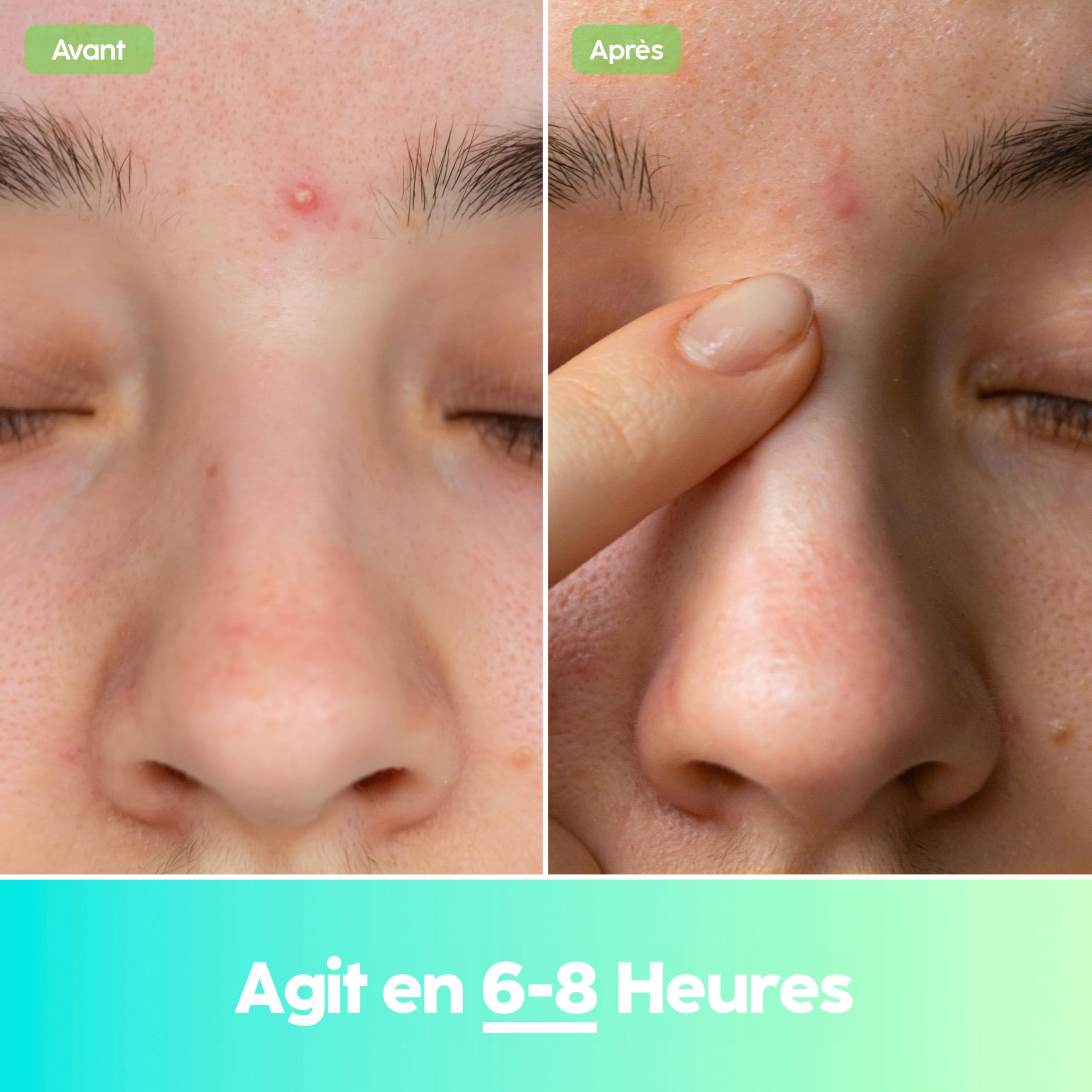 Patch Boutons (102 Unités) Pimple Patch en Hydrocolloïde Coréen, Absorbe les Impuretés, Utilisation de Jour et de Nuit, Invisibles Anti-Acné Bouton, Végétalien (2 Tailles)