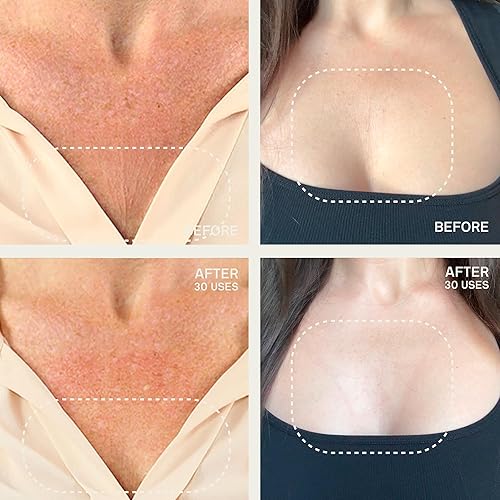 Miniatura 3 de Dermaclara Kit de parche de silicona para pecho y cuerpo, parches de silicona para el pecho, almohadillas antiarrugas reutilizables, tratamiento de