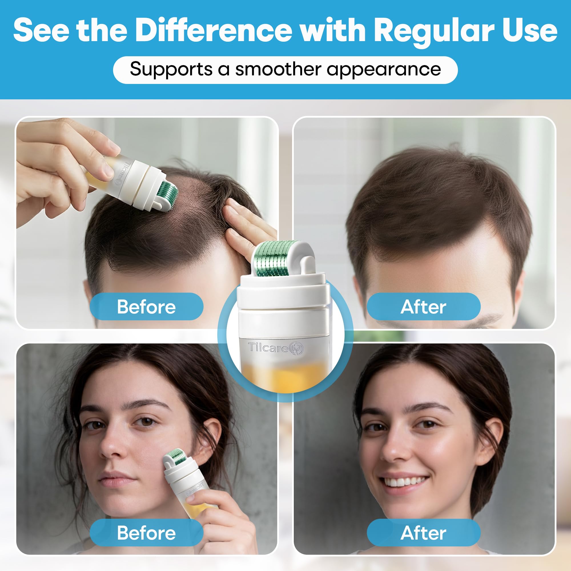 Derma Roller para Rostro, Cuero Cabelludo y Barba con Aplicador de Suero – Rodillo Capilar para el Cabello de 0,25 mm, Rodillo Capilar de Microneedling para Uso en Casa - Kit de Microneedling