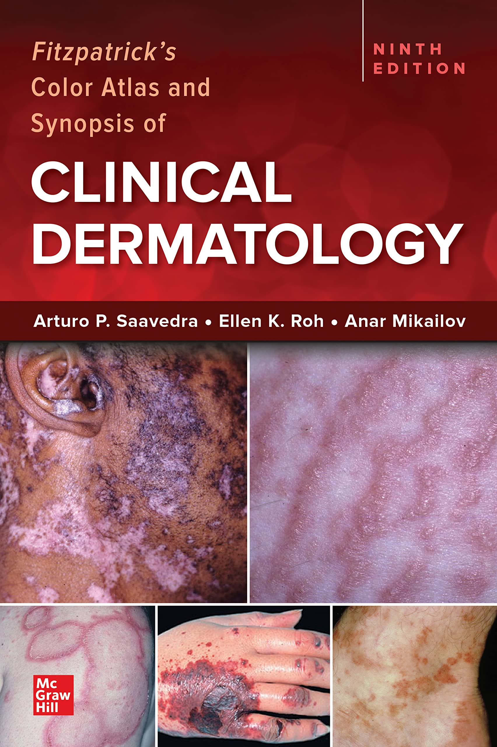 Fitzpatrick's Color Atlas and Synopsis of Clinical Dermatology, 9/e
