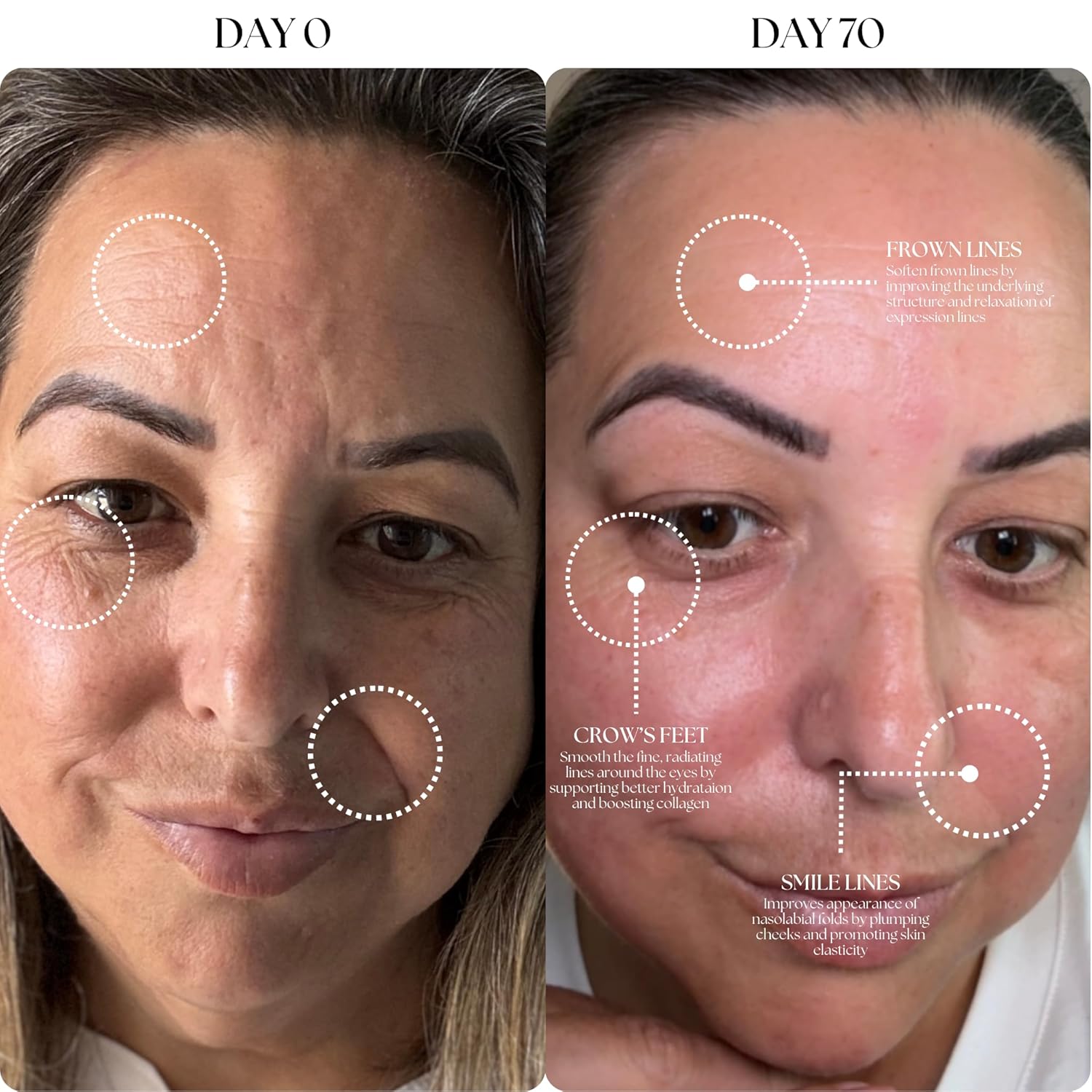 Mon Lumiere Micro-Infusion System - 0.25mm Gold Derma Spring-Loaded Stamp with PDRN & Peptides - At-Home Facial Kit for Collagen Boost & Fine Lines - Includes 3 Single-Dose Serums - Starter Kit - Image 8