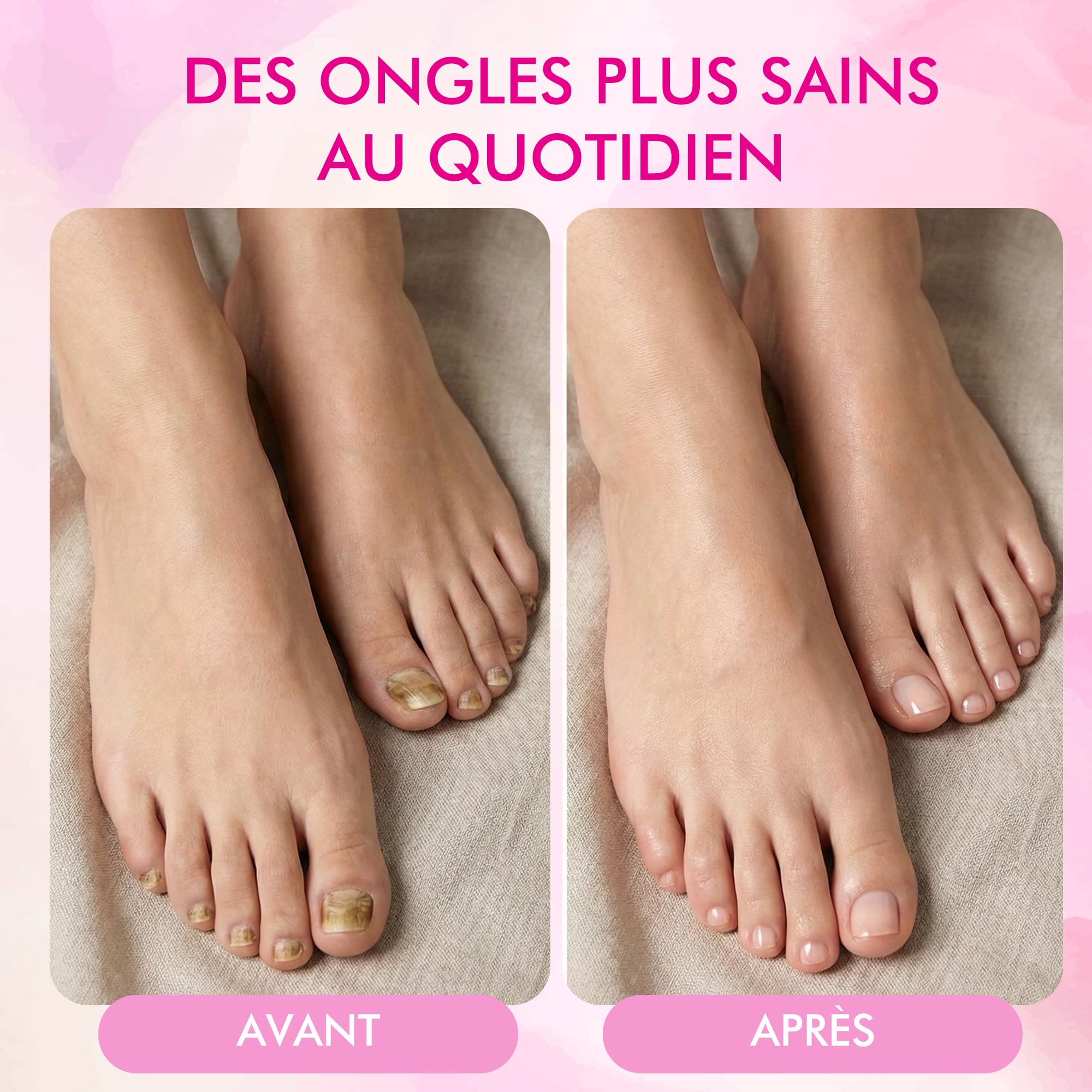 CARE | Traitement Mycose Ongle Pied Puissant, Lampe Laser Mycose Ongles Pied – Thérapie Lumière Rouge/UV Infrarouge, Appareil 2-en-1 LED/UV + Limes à Ongles & inclus