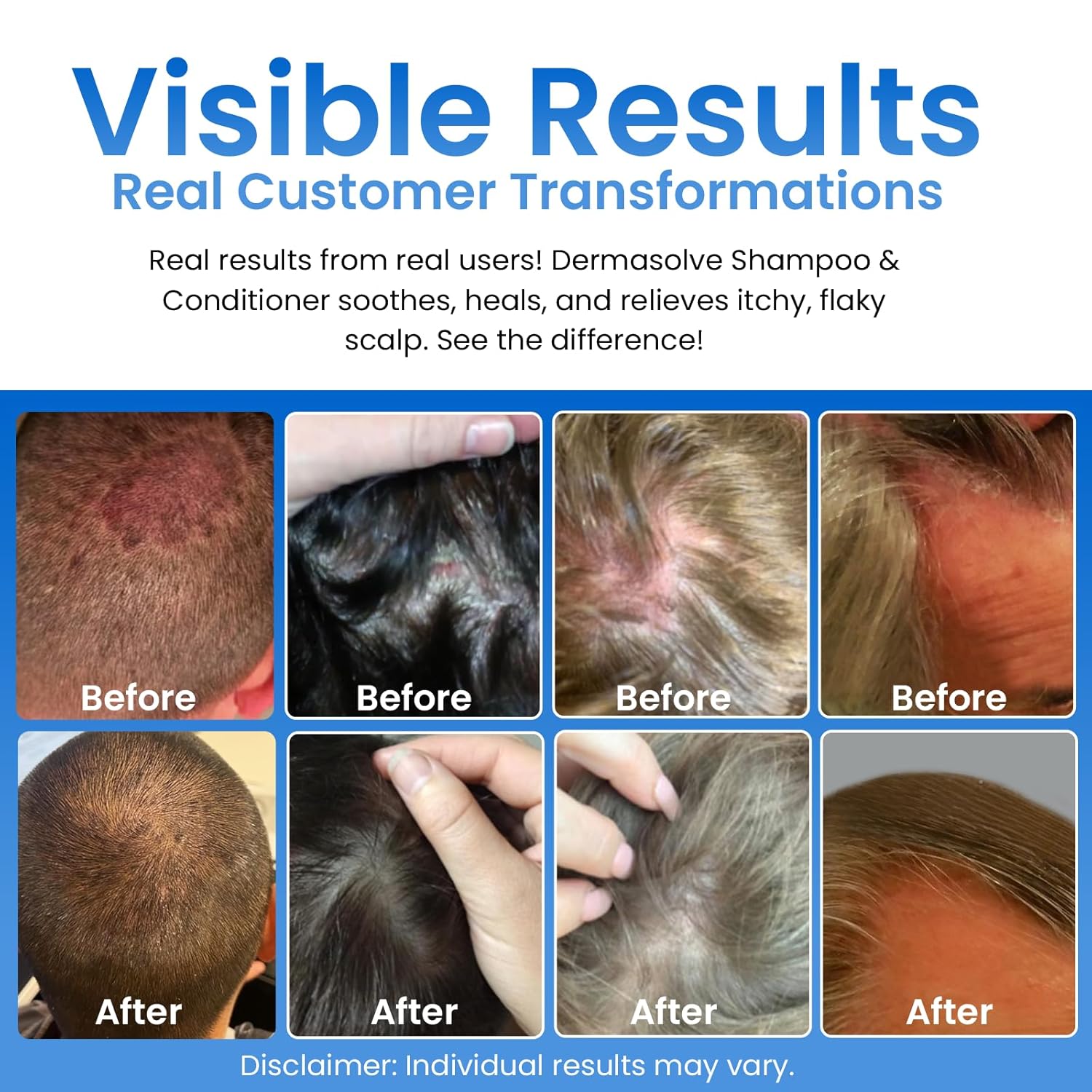 Dermasolve Psoriasis, Seborrheic Dermatitis & Dandruff Shampoo plus Conditioner. Naturally Heals Itchy Flakey Inflamed Skin and Provides Soothing Moisturizing Relief. (8.0 oz) - Image 3