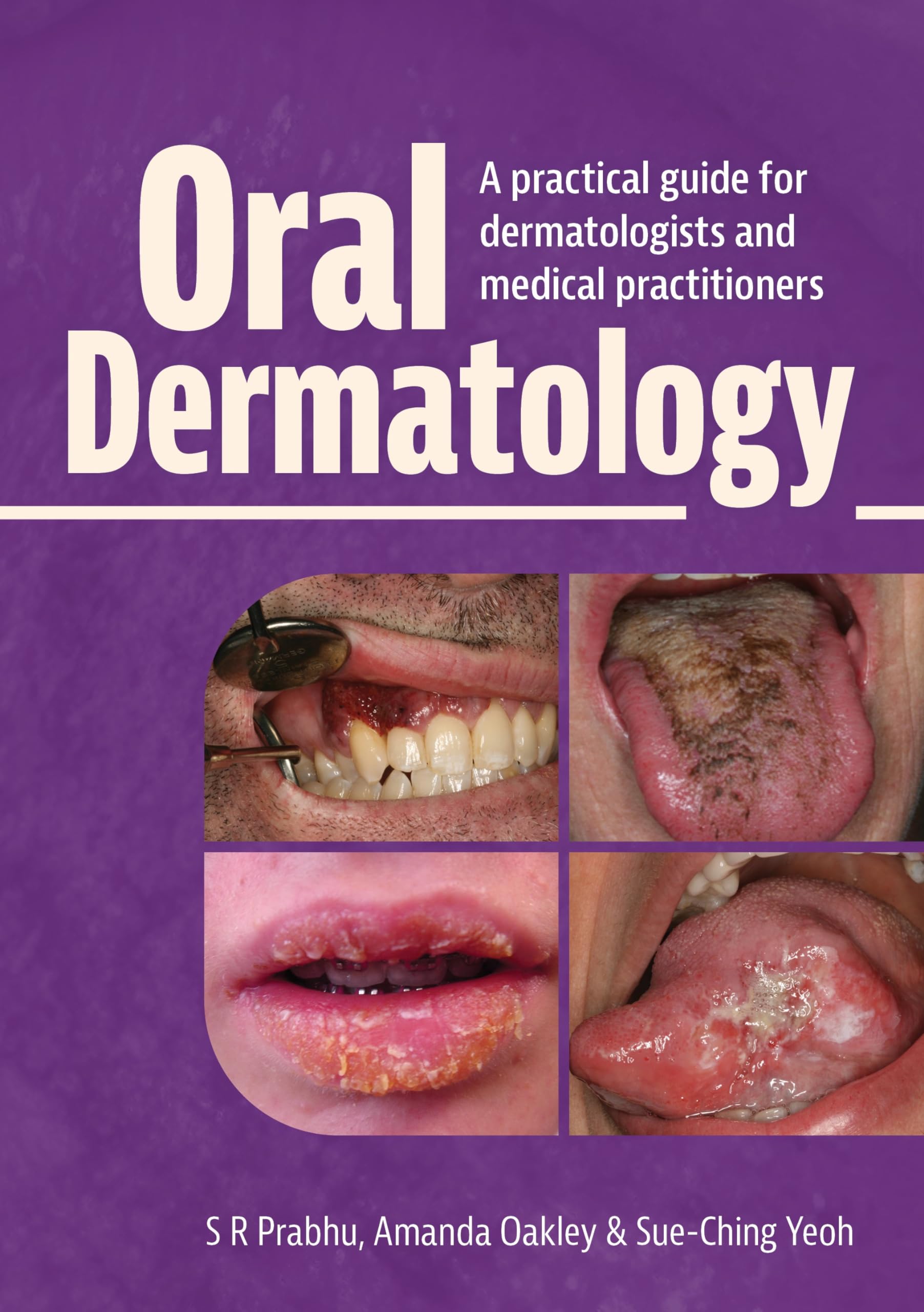 Oral Dermatology: A practical guide for dermatologists and medical practitioners