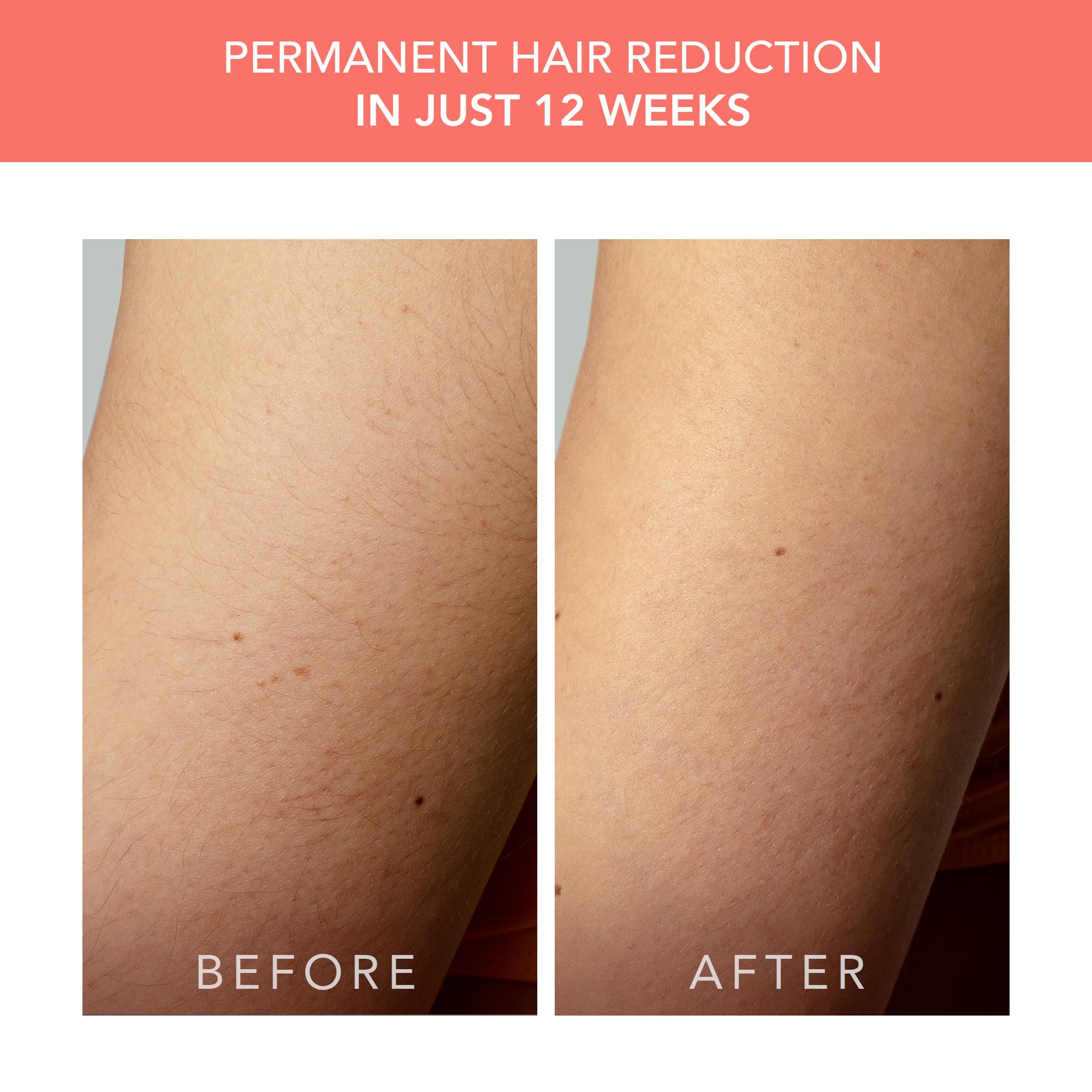 FOREO Peach 2 go IPL Hair Removal Device - Travel-Friendly Permanent Hair Removal - Laser Hair Removal - Body & Face - Painless Hair Removal - Skin Cooling & Silicone Shield - Customizable - Coral