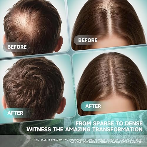 Miniatura 4 de Aceite de suero para el crecimiento del cabello para mujeres, romero, batana, arroz, agua, biotina, spray para el crecimiento del cabello, producto