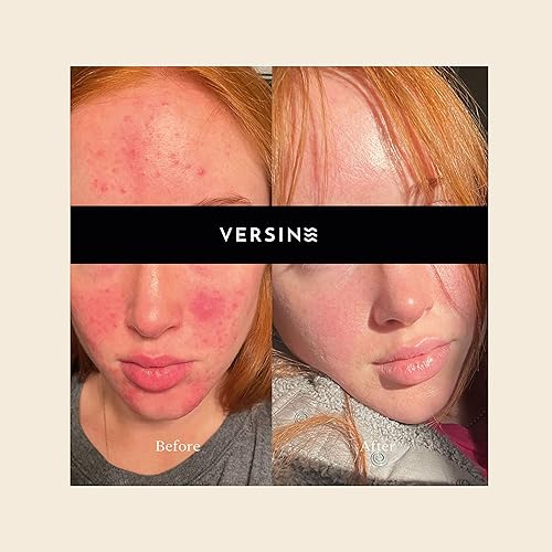 Miniatura 6 de Versine - Suero suave activo para la cara, piel propensa al acné, seguro para el embarazo con ácido azelaico, vitamina C, escualano, niacinamida,