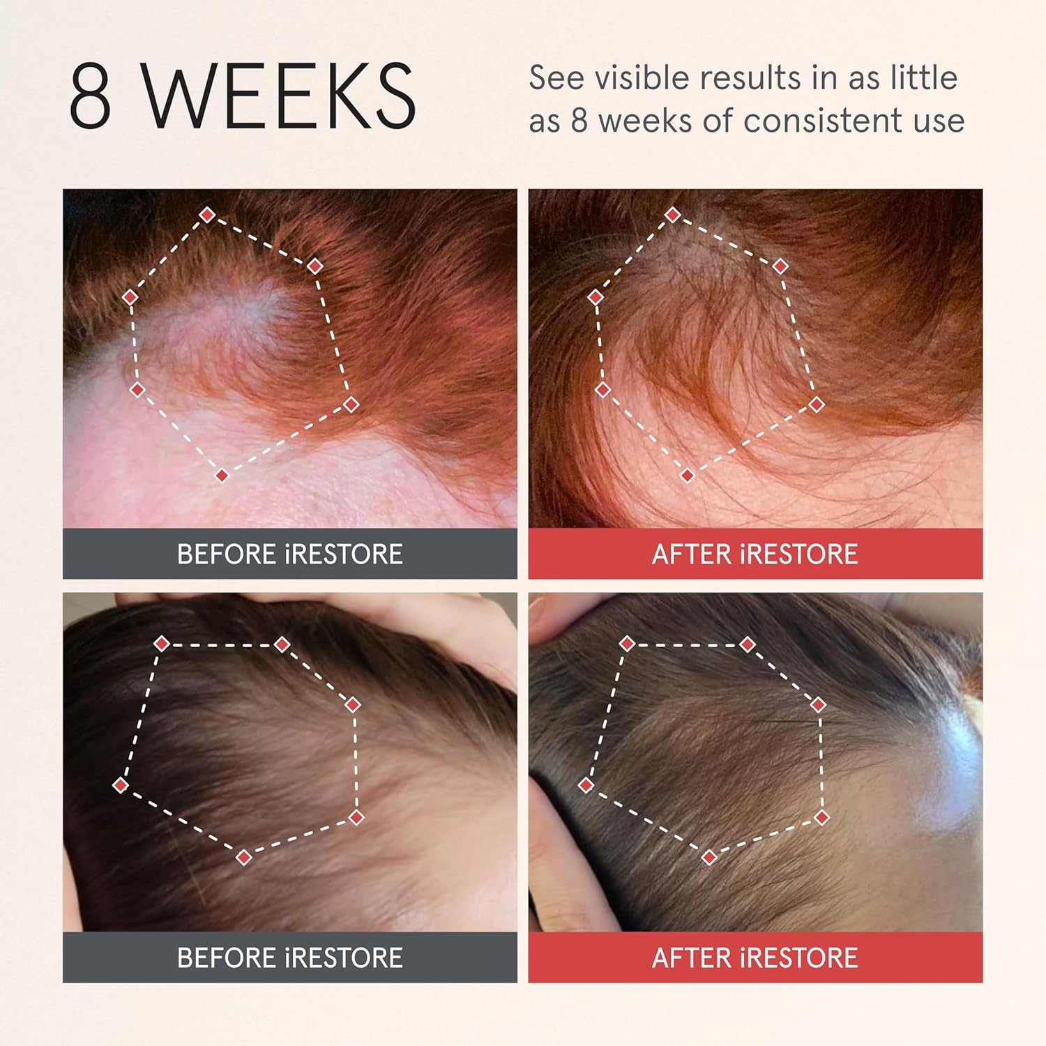 iRESTORE Scalp Serum | Hair Growth Serum for Women Men | Best for Hair Loss Hair Thinning | Aids Regrowth with Redensyl Capixyl & Biotin | Hydrates Scalp for Visibly Thicker Fuller Hair - 2 Fl Oz - Image 2