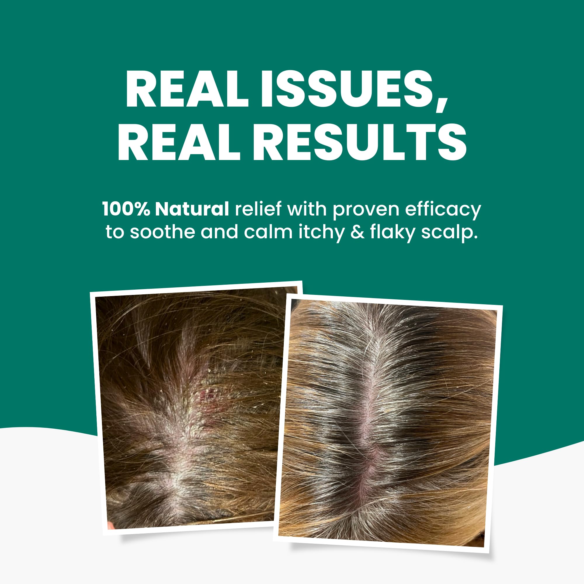 Grahams Natural Scalp Relief Oil, for Dry Itchy & Flaky Scalp Psoriasis, Seborrheic Dermatitis & Dandruff Treatment - Image 3