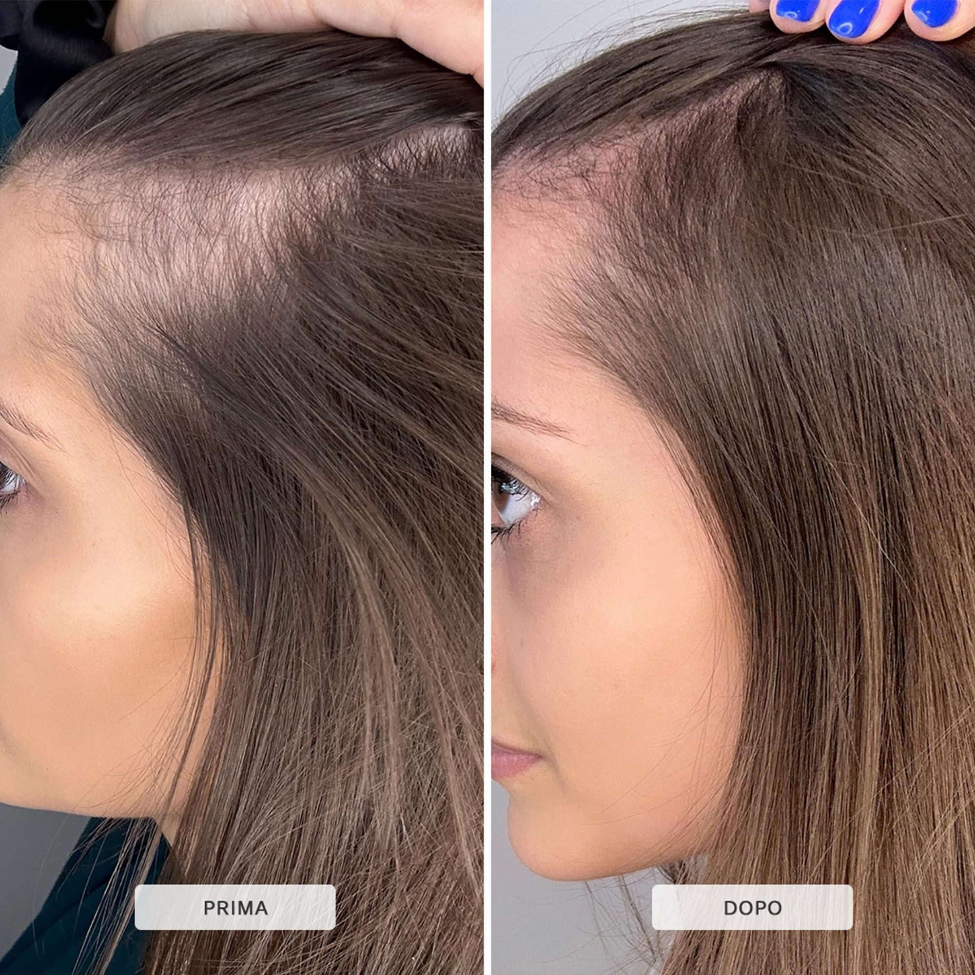 HAIRBURST Siero Intensivo per Capelli e Cuoio Capelluto con Capixyl e Procapil - Olio di Rosmarino per la Crescita dei Capelli, Olio di Ricino Biologico, Olio per Ciocche più Spesse e Forti