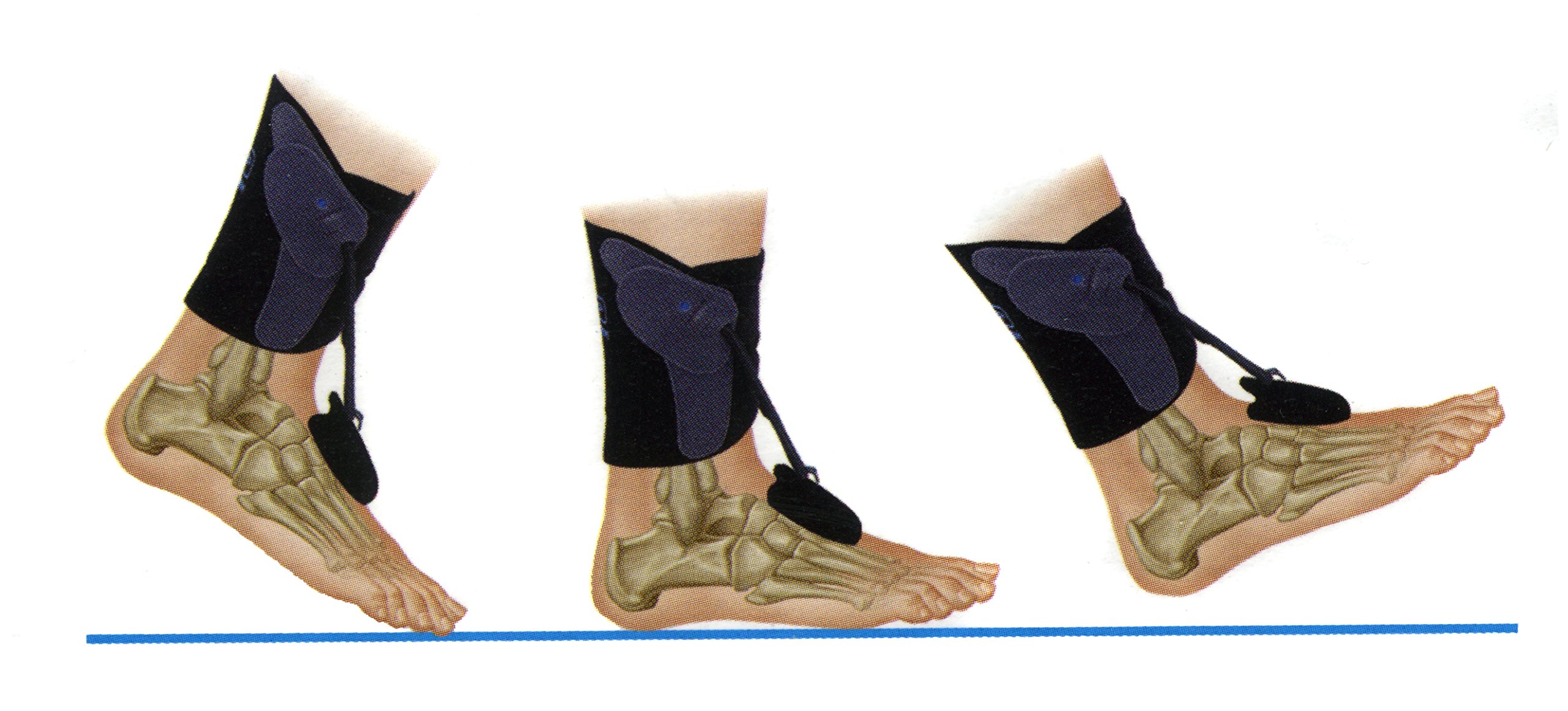 The Pioneering 'AIRMED' AFO Drop Foot Orthosis For Paralysis Drop Foot