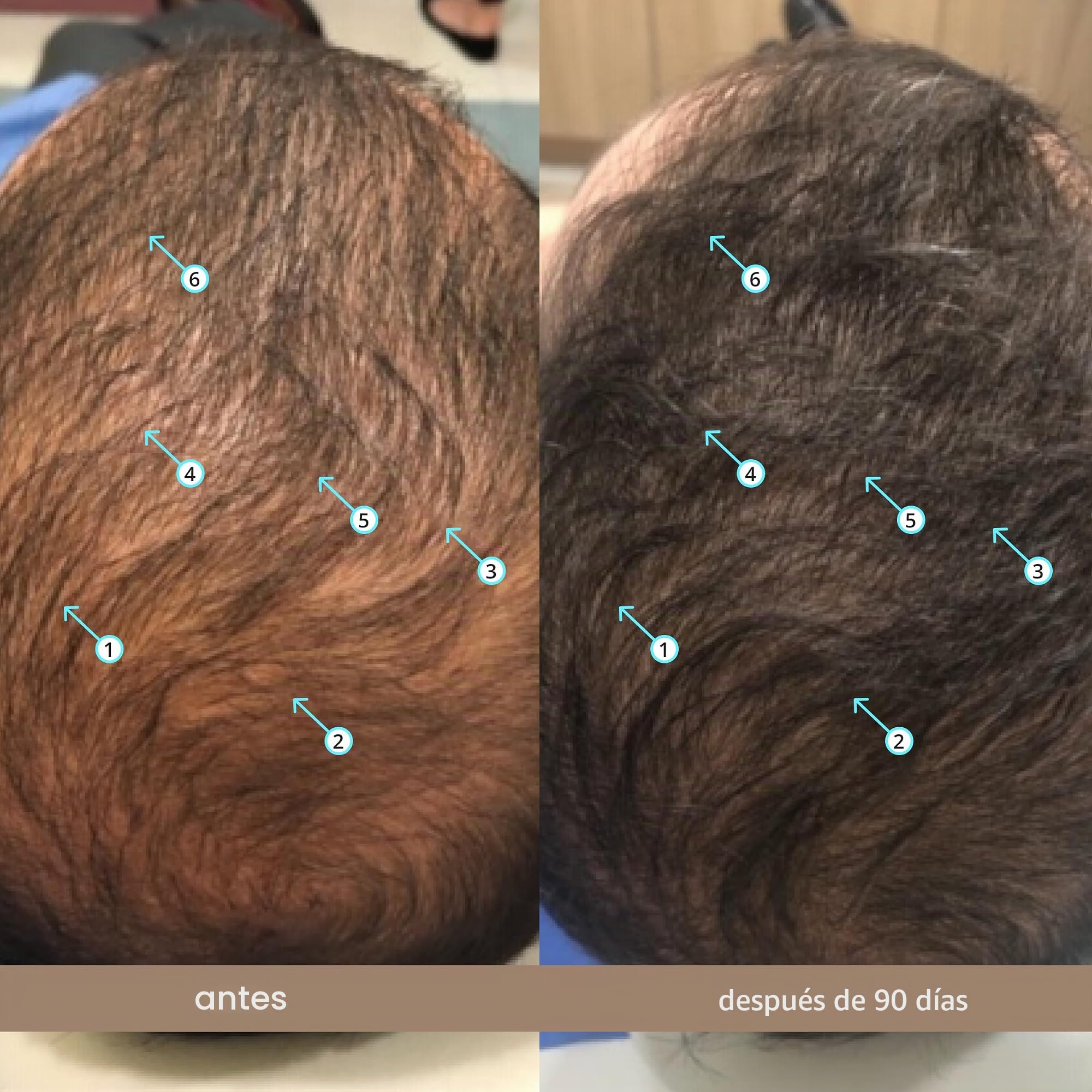 Spectral.DNC-N Tratamiento anticaída de DS Laboratories, Ayuda a reducir la caída del cabello y estimula el crecimiento del cabello, Fórmula con Nanoxidil 5% (60ml)