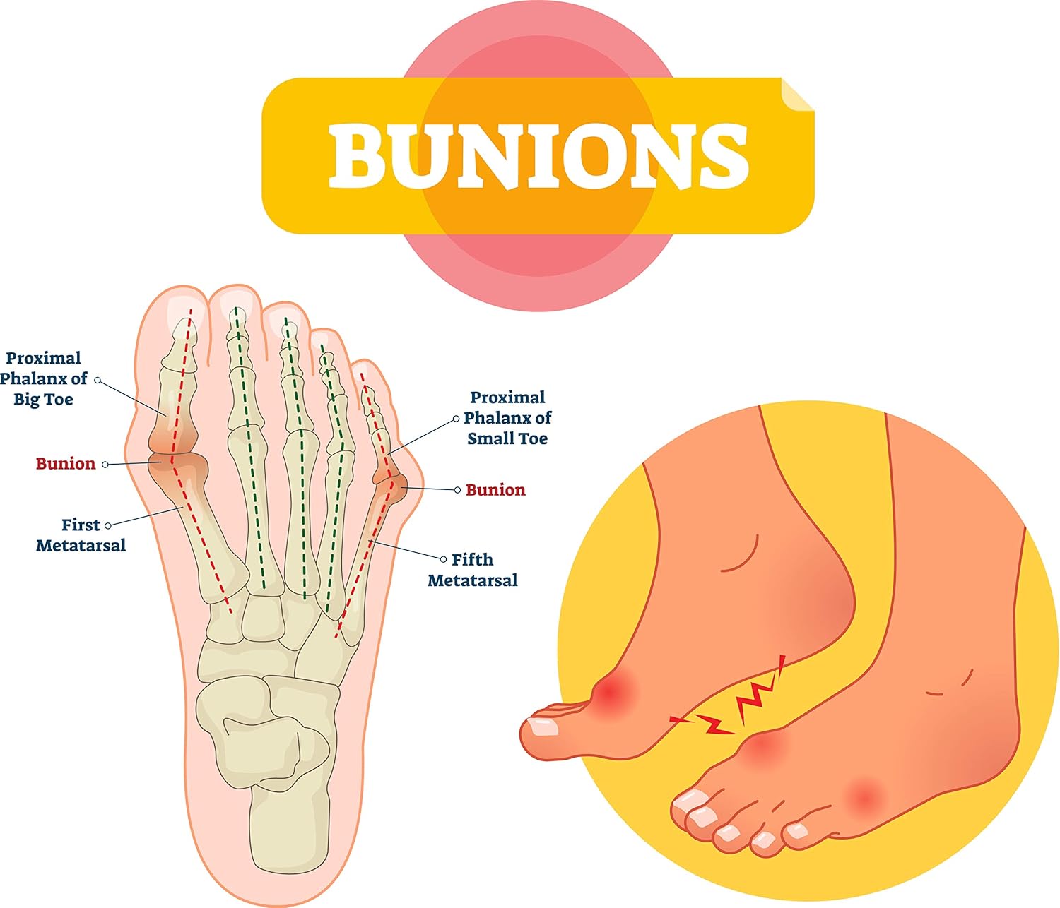 pedag Bunion Protector and Forefoot Pad, Made in Germany, Cushions and Protects Bunions from Irritation, Eases Pain, Easy to Put On, Reusable, Washable, Reversible, 1 Per Pack, Small/Medium : Health & Household