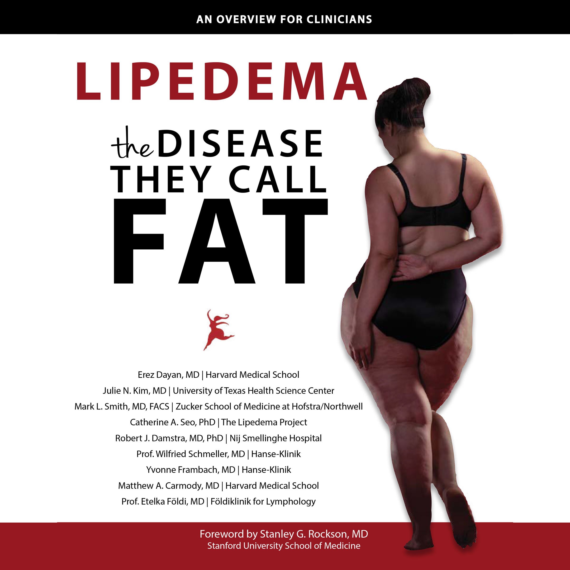 Lipedema - The Disease They Call FAT