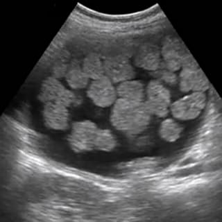 ARRT Sonography (Ultrasound) Flashcards Lite