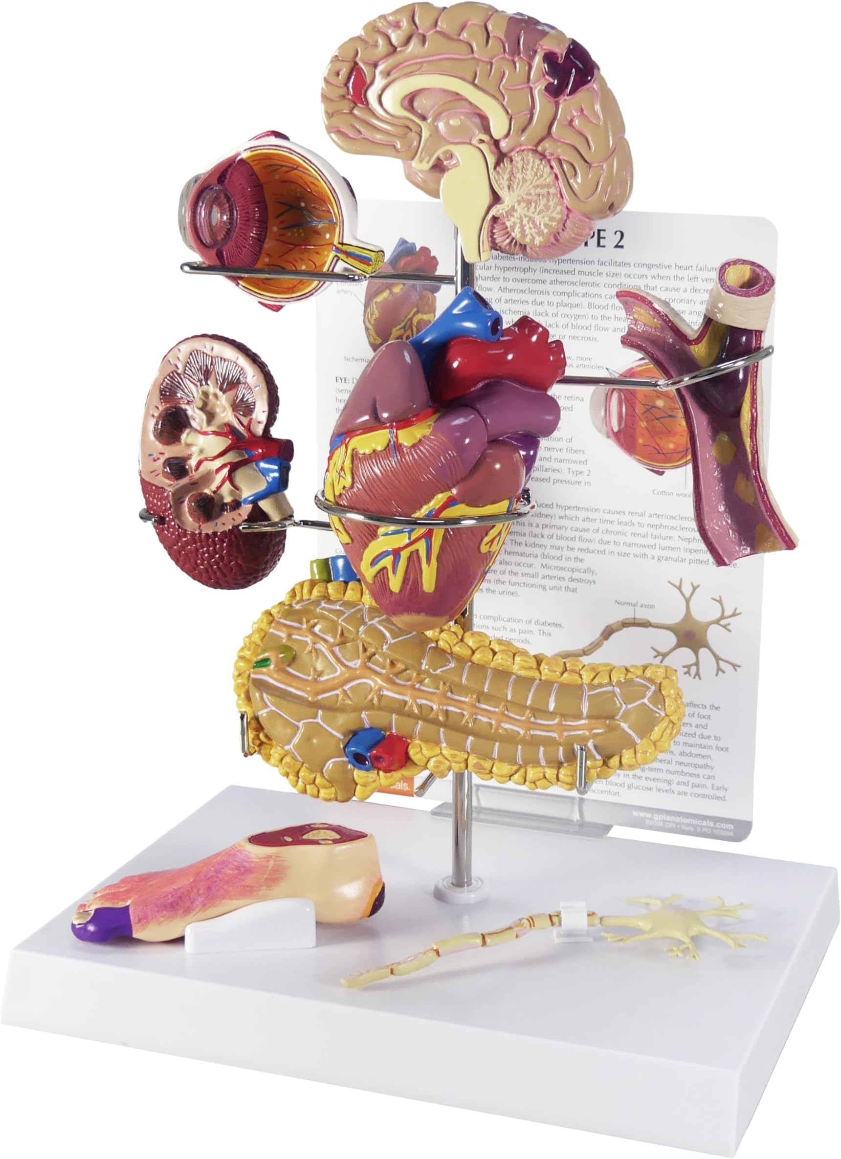 - GPI Anatomicals - Type II Diabetes Model Set, Replica for Human Anatomy and Physiology Education, Anatomy Model for Doctor's Offices and Classrooms, Medical Learning Resources