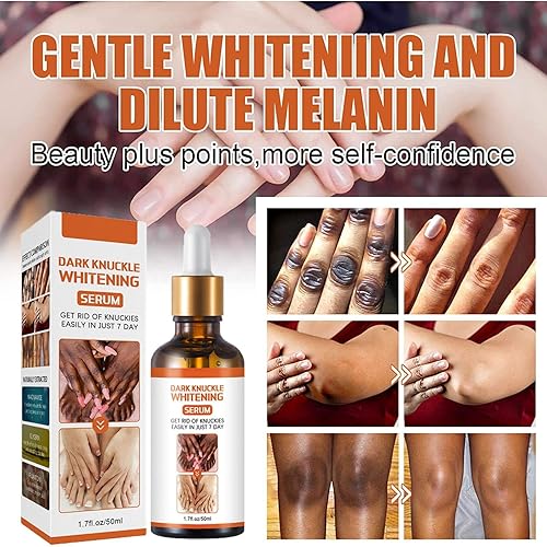 Miniatura 3 de Acanthosis Nigricans - Corrector de manchas oscuras para acantosis, manchas oscuras para aclarar la piel negra, suero iluminador de la piel, para