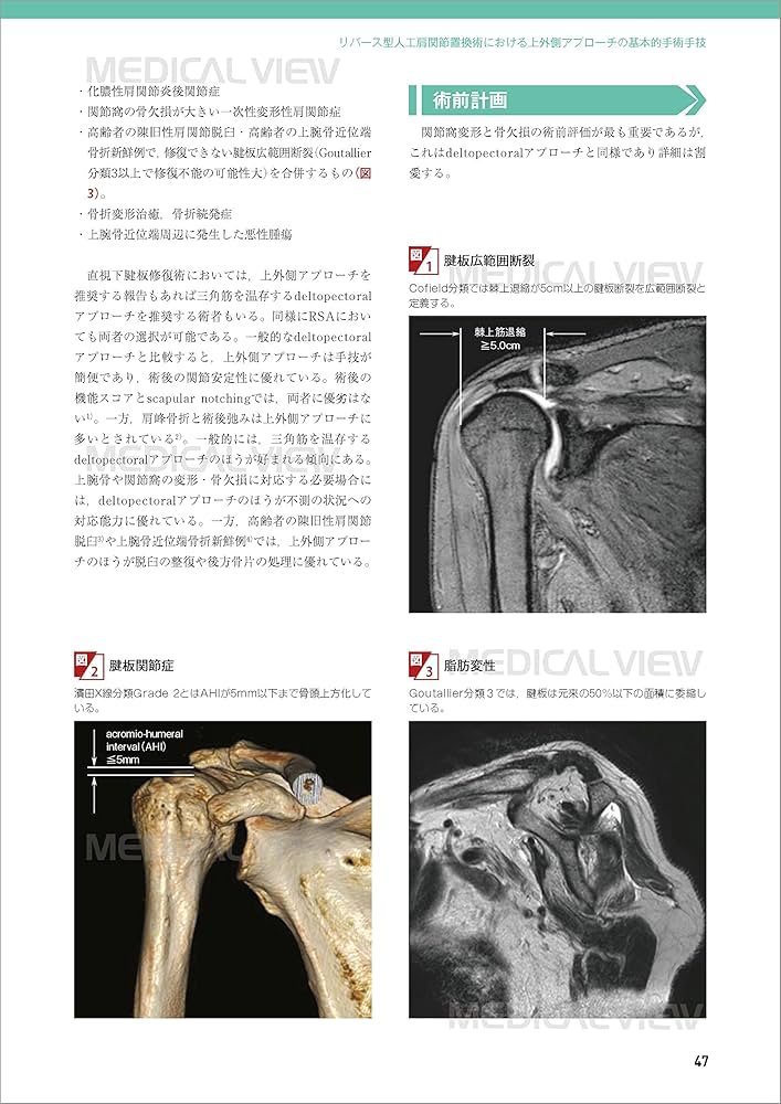 上肢の人工関節手術［Web動画付］ (新OS NEXUS No.5) | 今井 晋二 |本