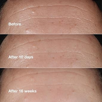 Clinique Smart Clinical Repair Wrinkle Correcting Anti Aging Face Serum With Hyaluronic Acid, Peptides + Advanced Retinoid Serum For All Skin Types | Hydrating