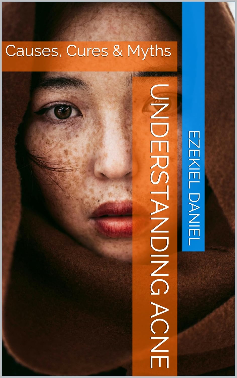 Understanding Acne: Causes, Cures & Myths