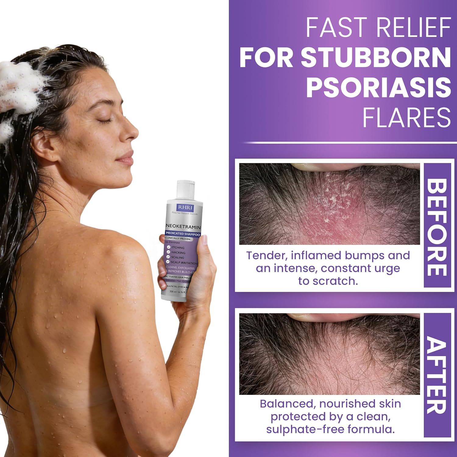 Anti Fungal Shampoo for Men & Women | Anti Dandruff, Medicated, Folliculitis Shampoo for Dry Scalp, Psoriasis, Ringworm | for Itchy, Flaky & Irritated Scalp | No Paraben & Sulphate | w/Scrubber Brush - Image 4