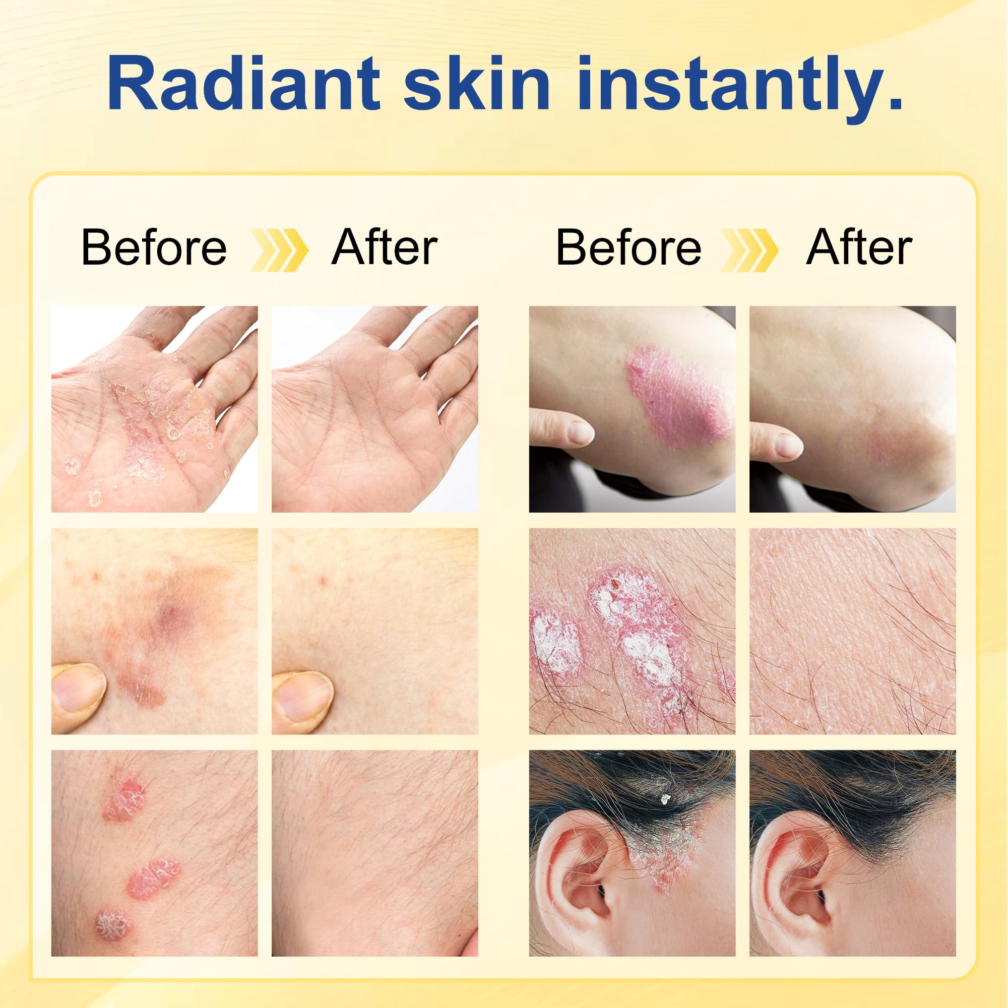 Psoriasis Cream, Natural Seborrheic Dermatitis Relief for Itchy Flaky Skin, Soothing Ointment for Redness & Scaling 20g - 5