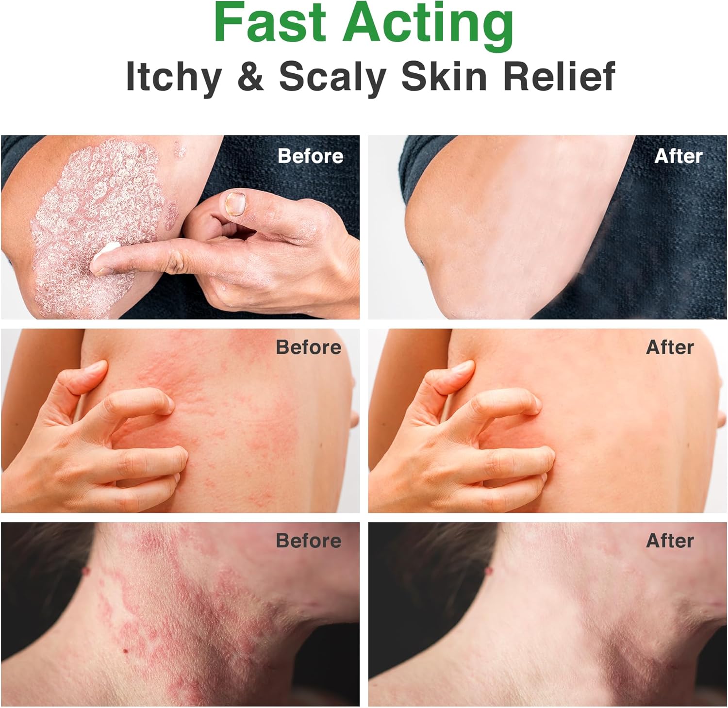 PLENO Ringworm Treatment for Humans: Antifungal Spray for Jock Itch, Eczema, Tinea Versicolor, Athletes Foot - Antifungal Cream for Rash & Itchy Skin - Image 4